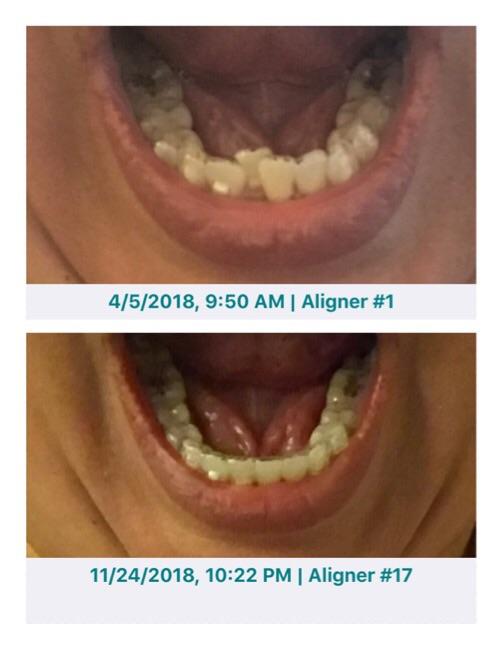 Tray 17/24 two week changes progress! Invisalign