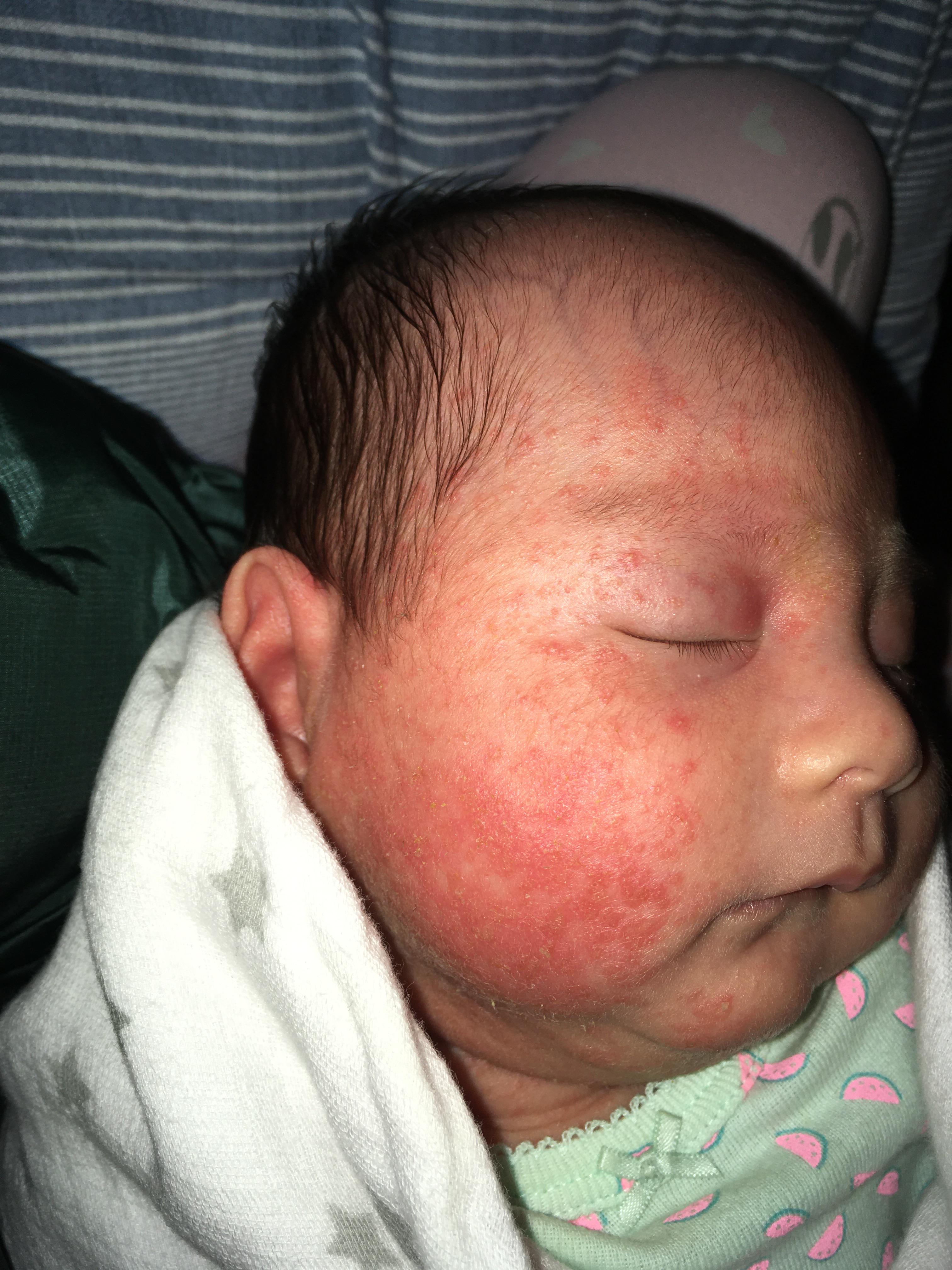 Is this baby acne or something else? r/NewParents