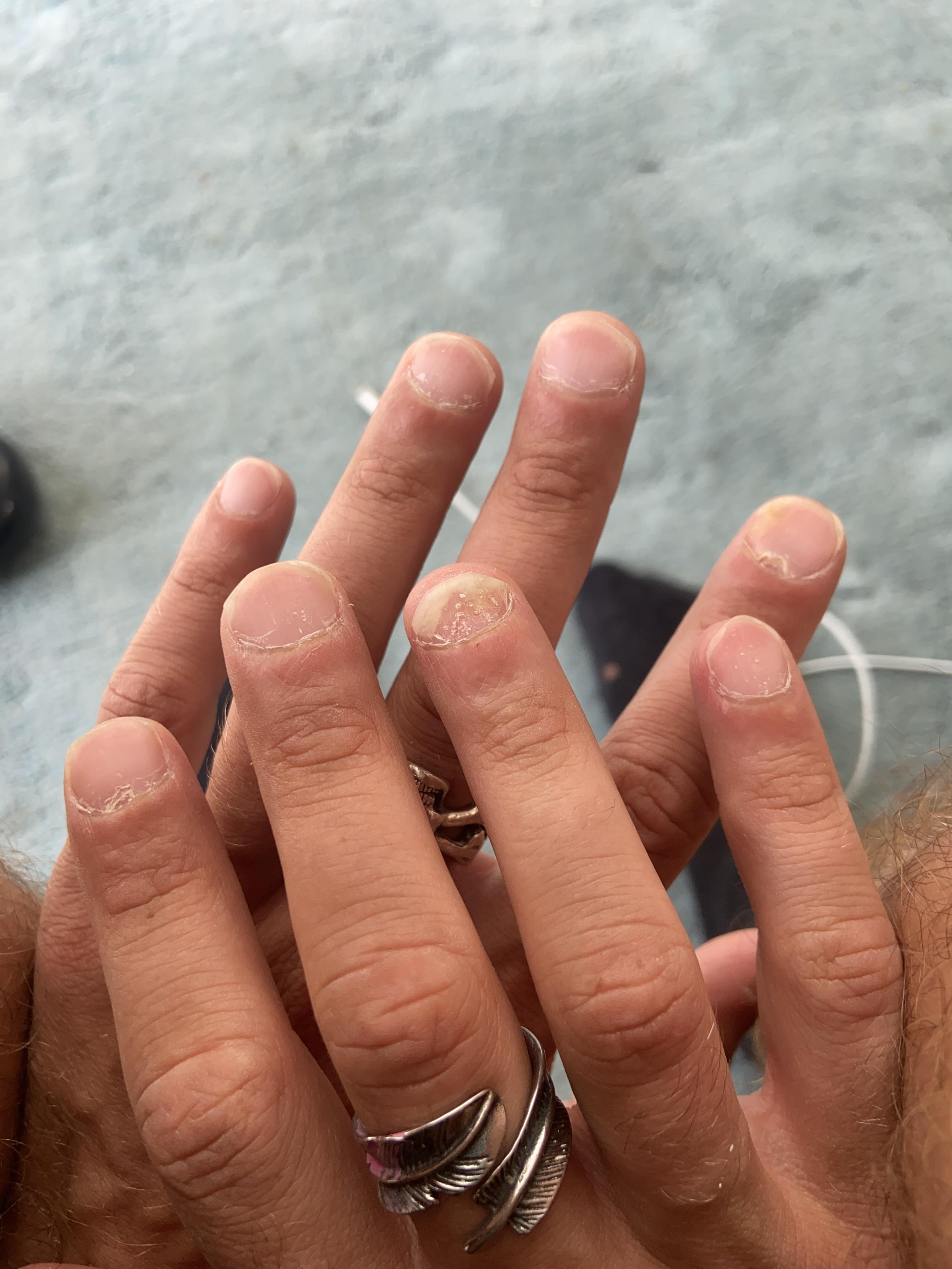 My nails are eating themselves! Any solutions for nail psoriasis? r