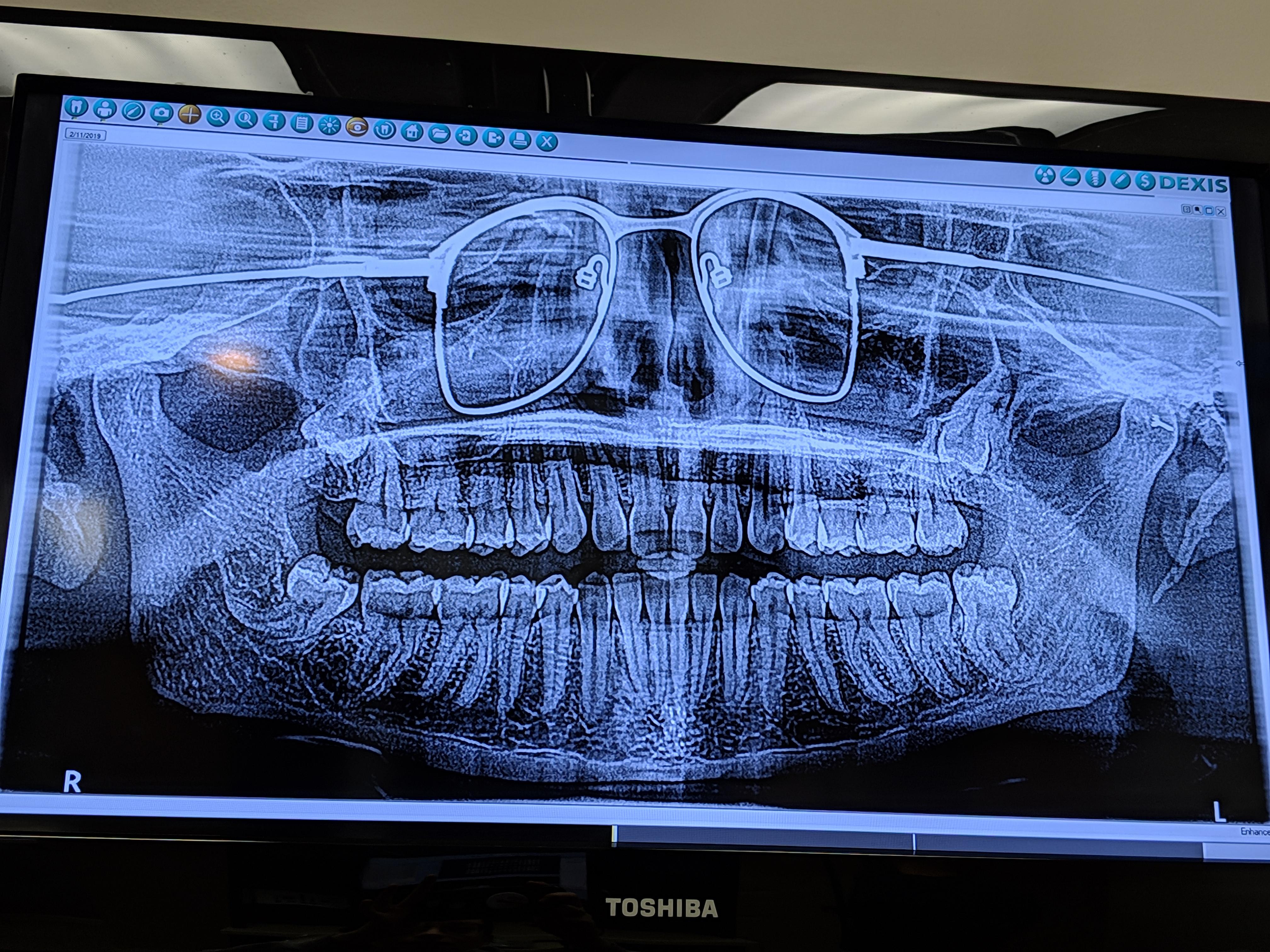 I got a panoramic xray of my teeth the other day. The dentist to