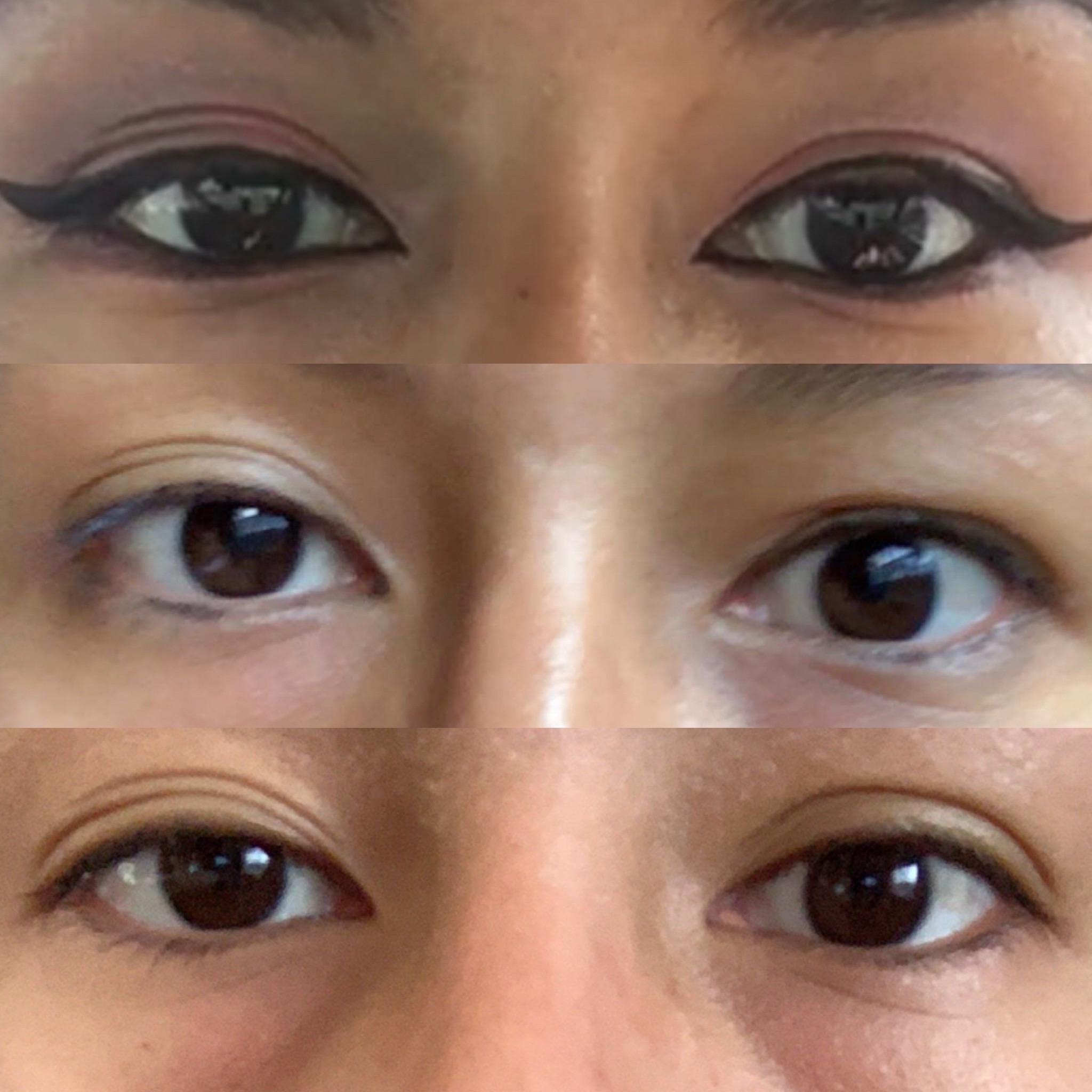 My journey with Graves eye disease r/gravesdisease