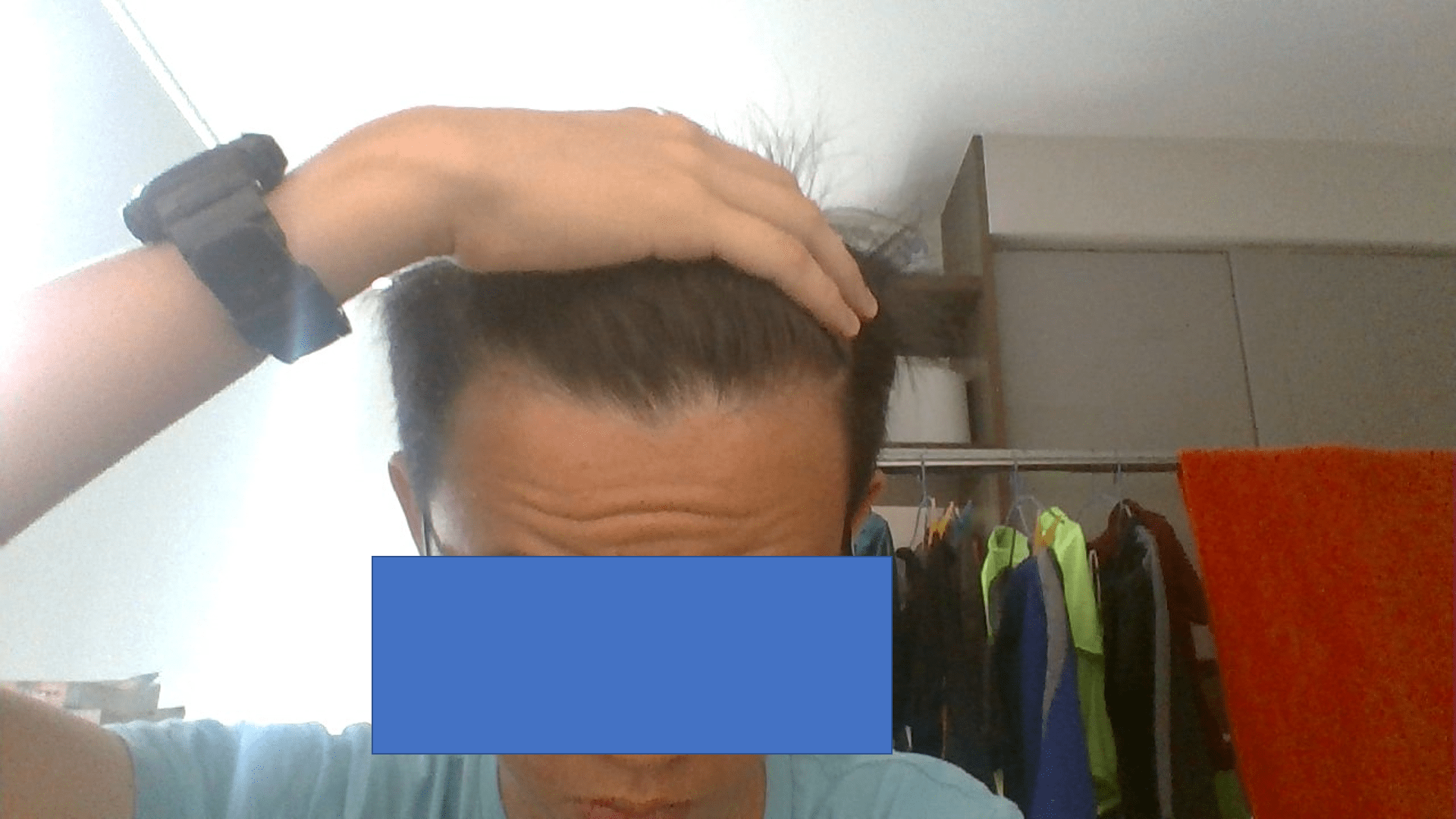 Where am I on the Norwood scale? r/malehairadvice