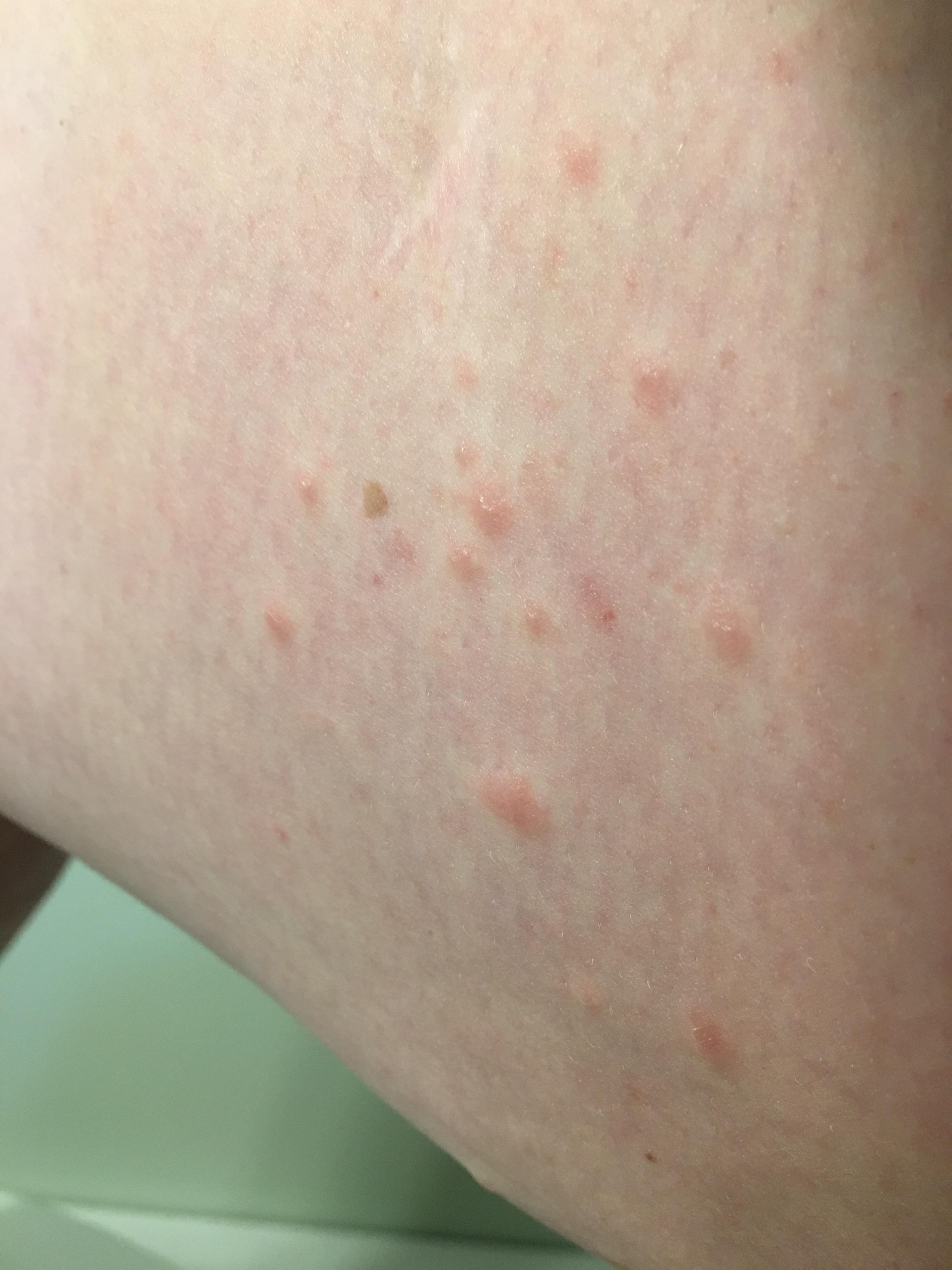 Cluster of raised bumps on inner thigh. Not itchy. Any ideas? r