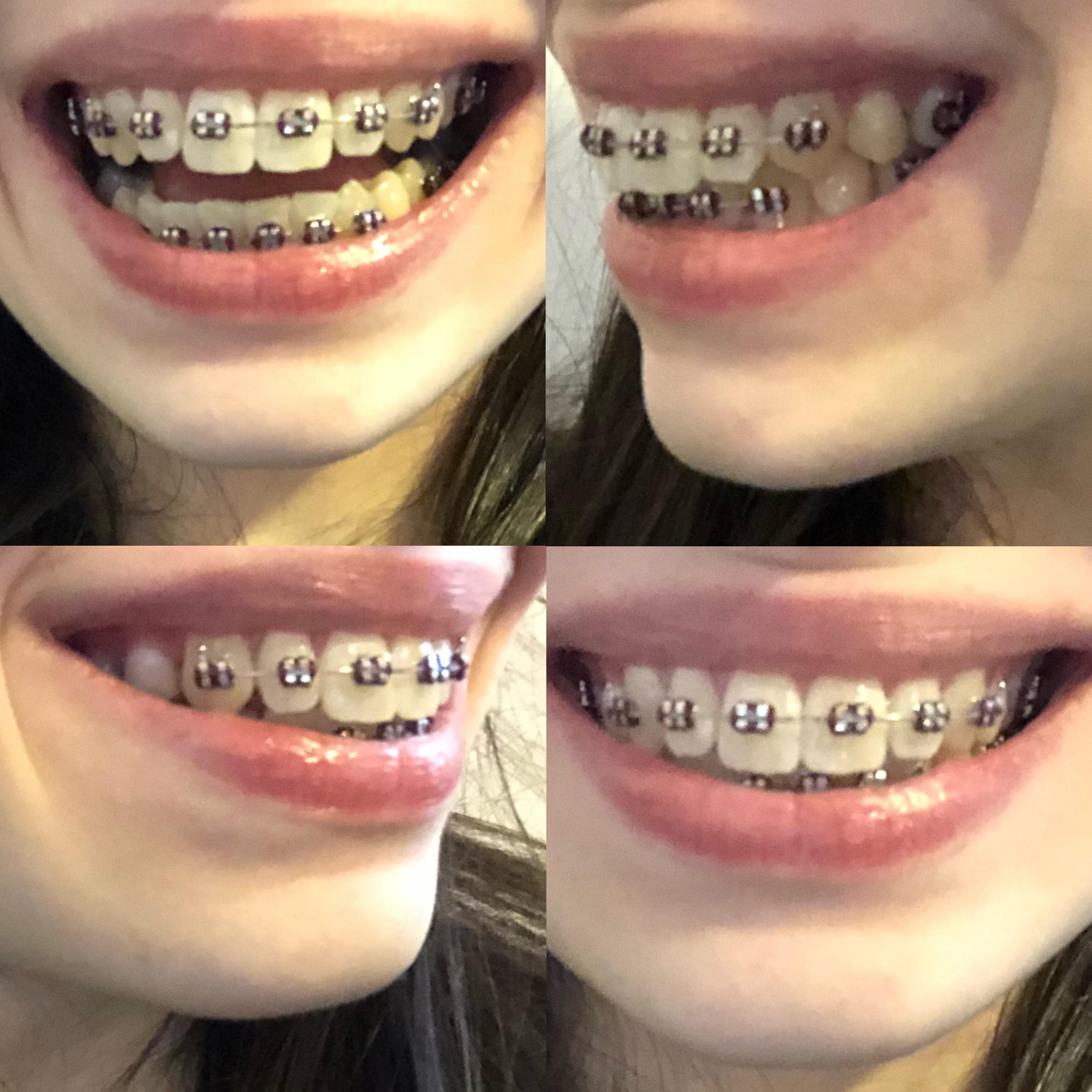 People who have had experience with premolar extraction, do you think