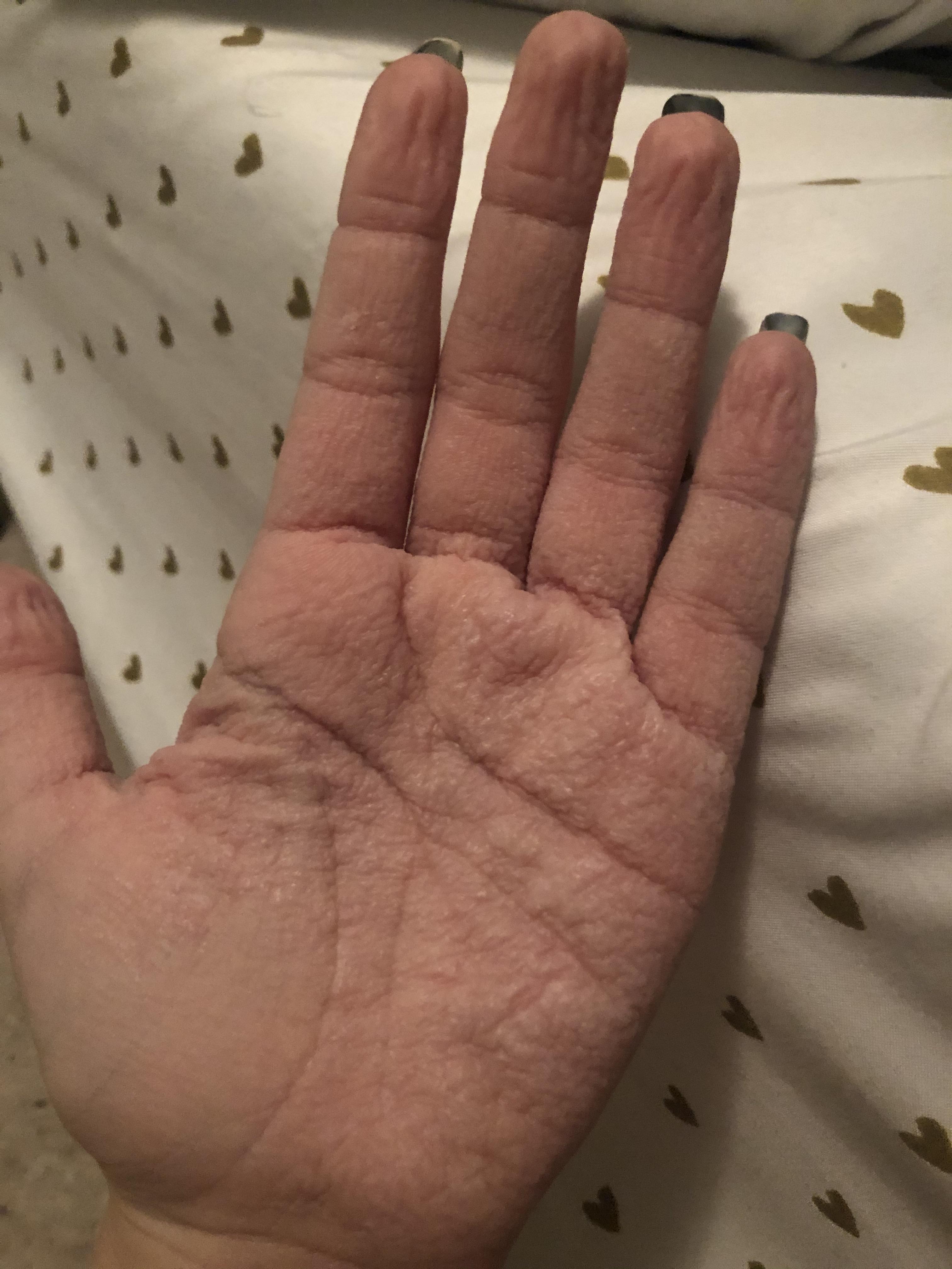 So this is my left hand after a shower, or being in water. It doesn't