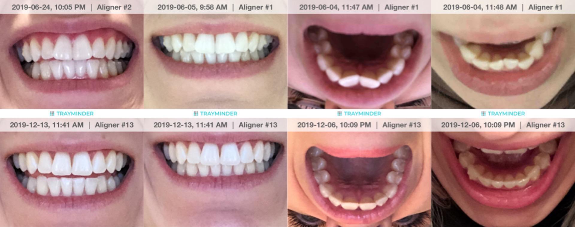 Before and after 13/13. On to refinements in the new year! r/Invisalign