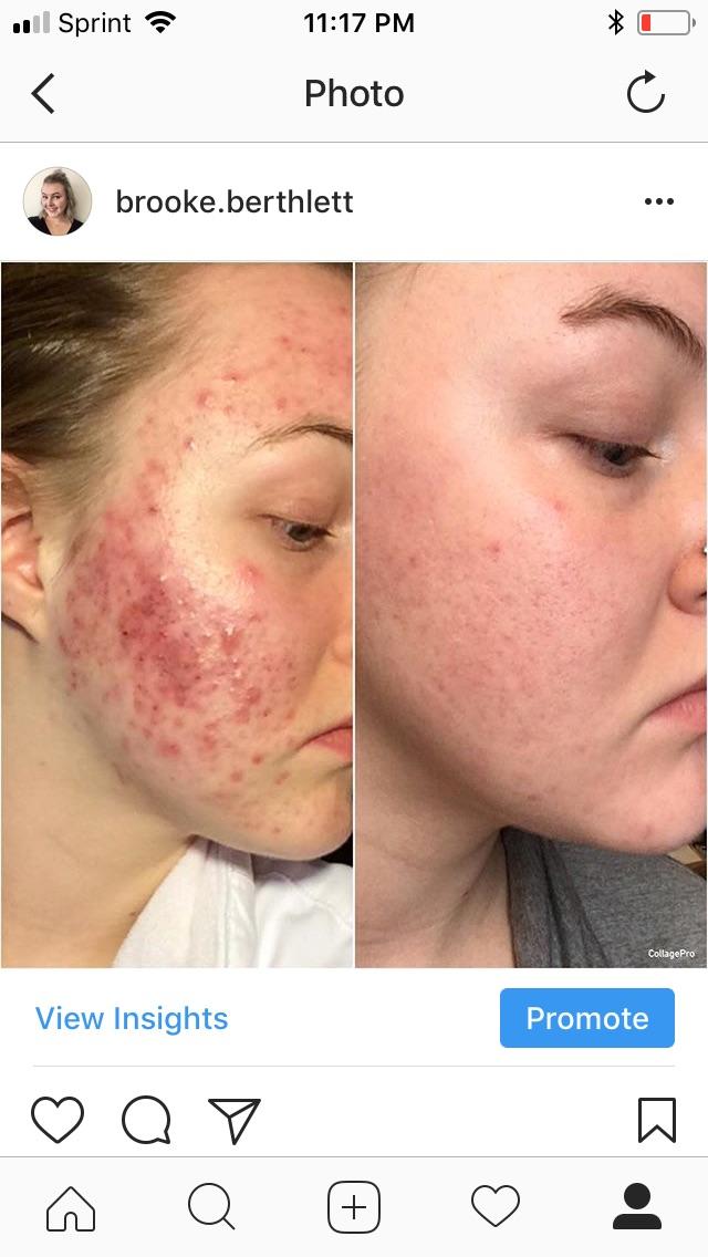 Extreme cystic acne progress r/Skincare_Addiction
