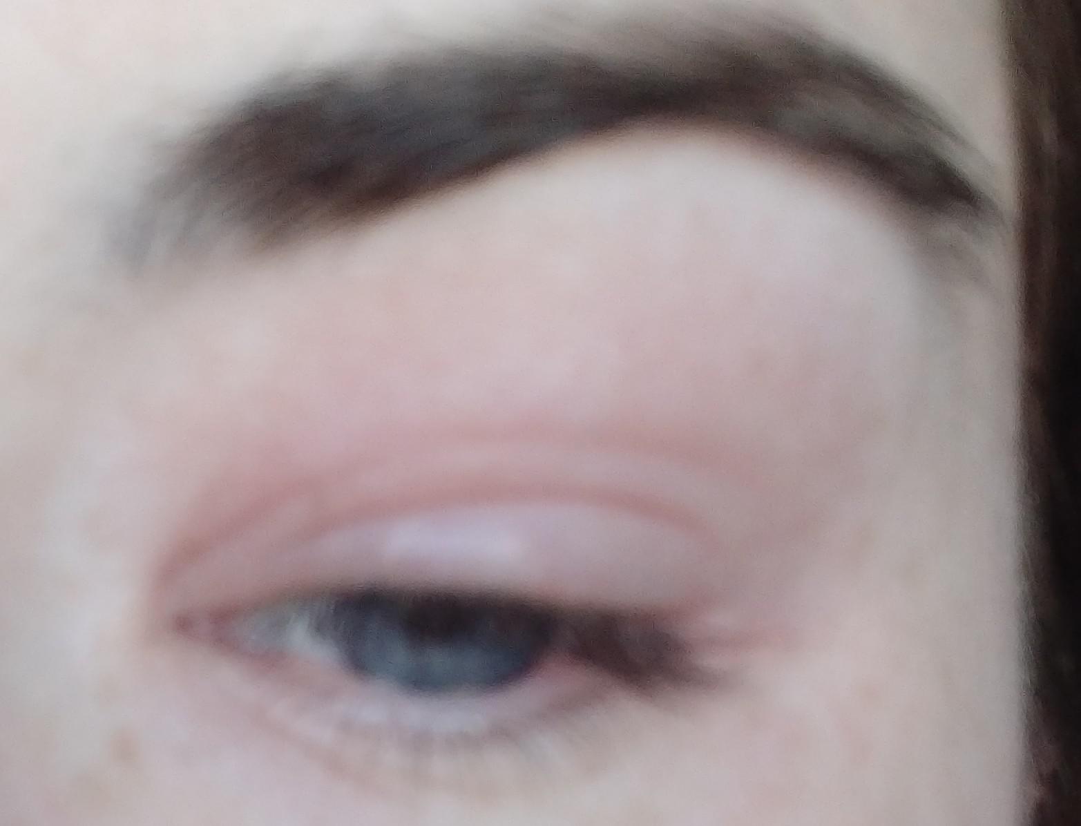 Has anyone got any advice for eyelid eczema please? I have stopped