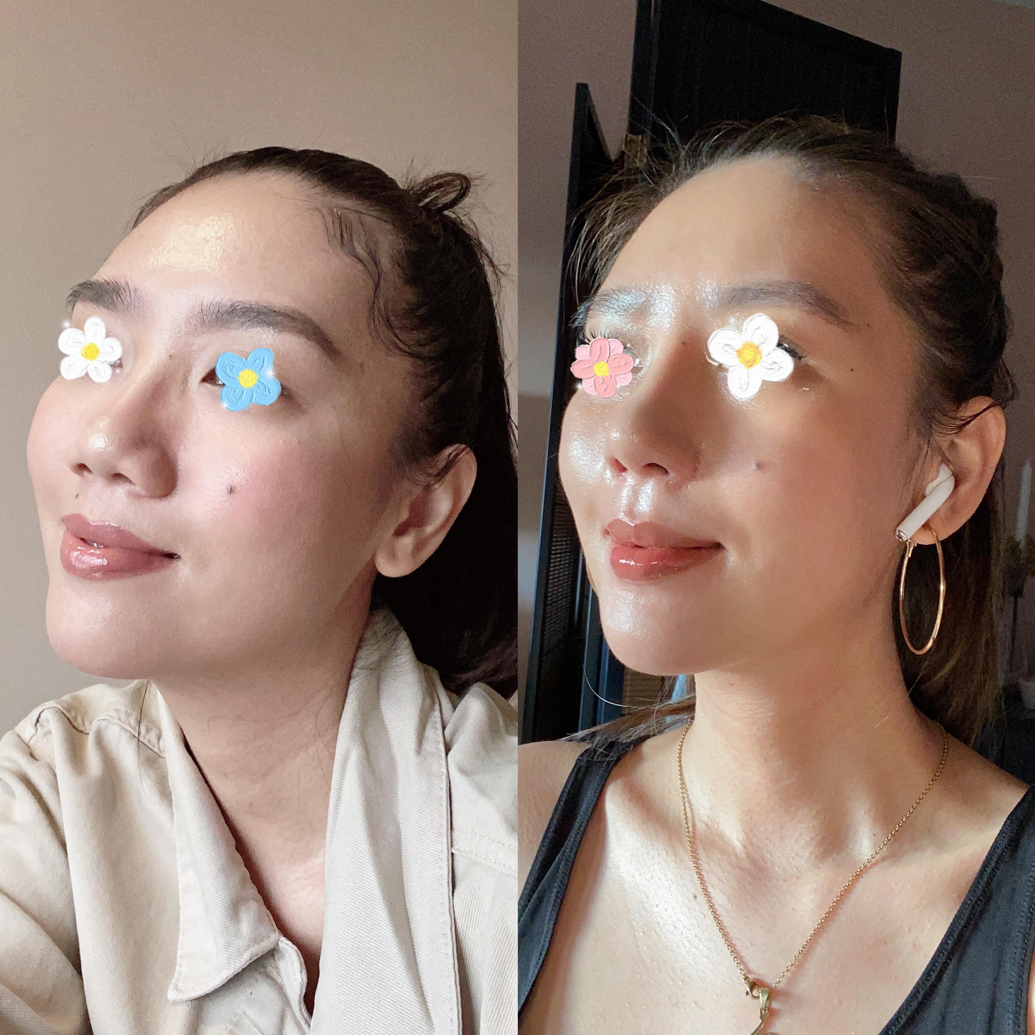 Dr Edwin Del Rosario Rhinoplasty Outlet innoem.eng.psu.ac.th