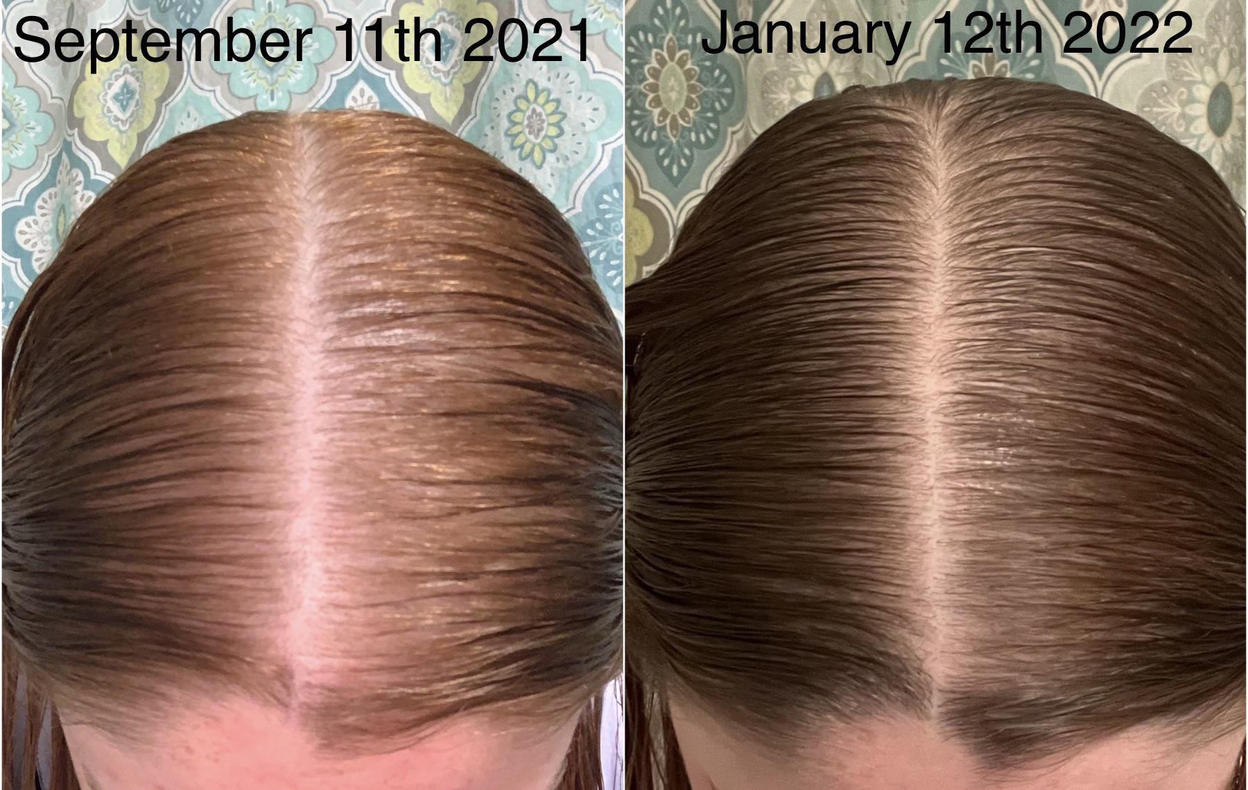 Four month progress on 5 minoxidil foam! TE from stopping birth