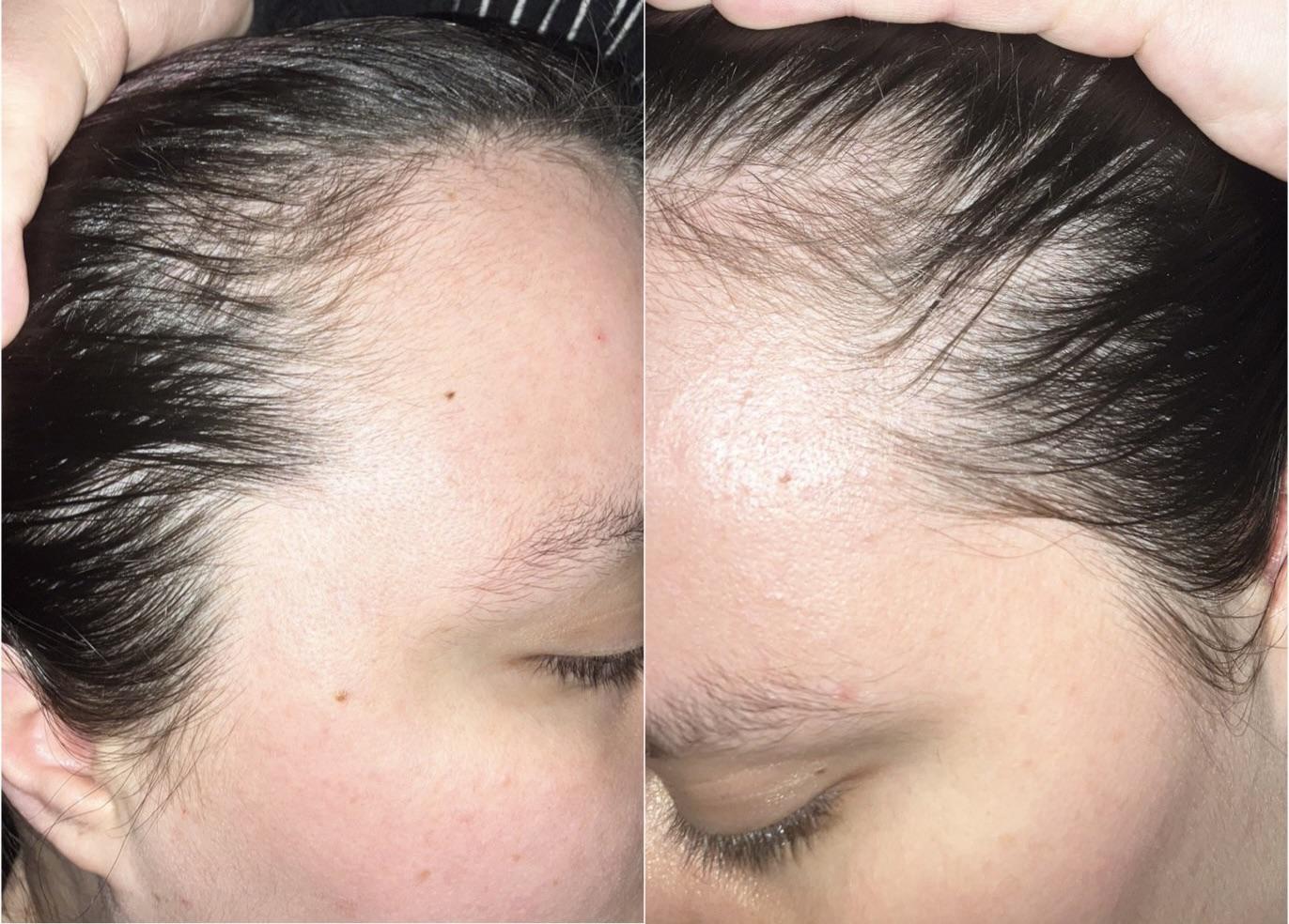 Hair loss, cause unknown. Has anyone else experienced this? r