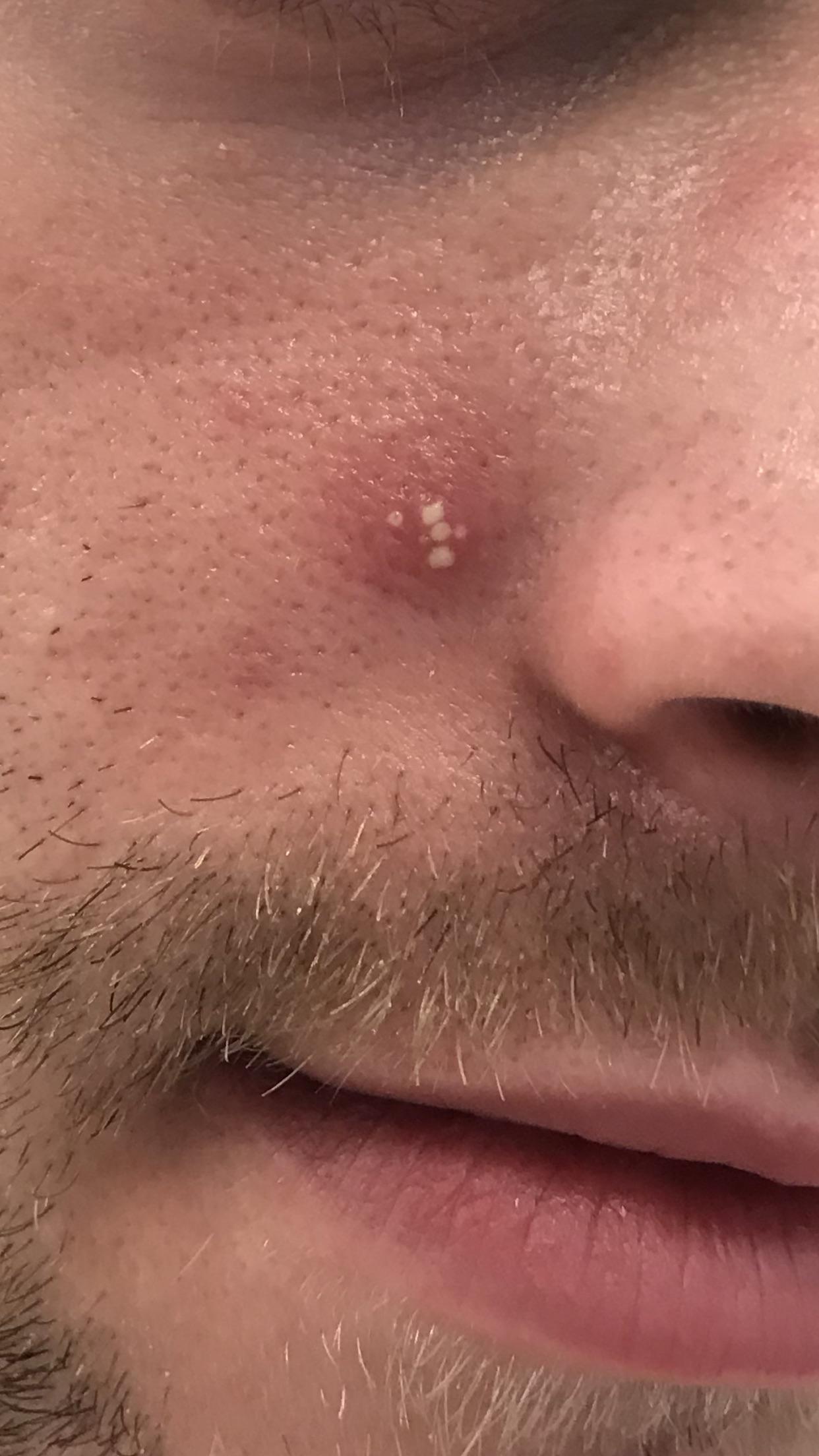 [acne] help me get rid of this multihead pimple. r/SkincareAddiction
