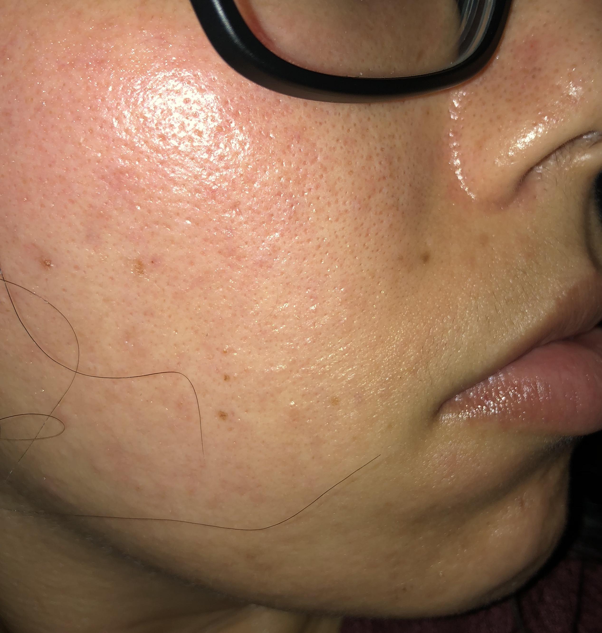 [Skin Concerns] Large pores, Uneven Skin Texture, Redness....Any