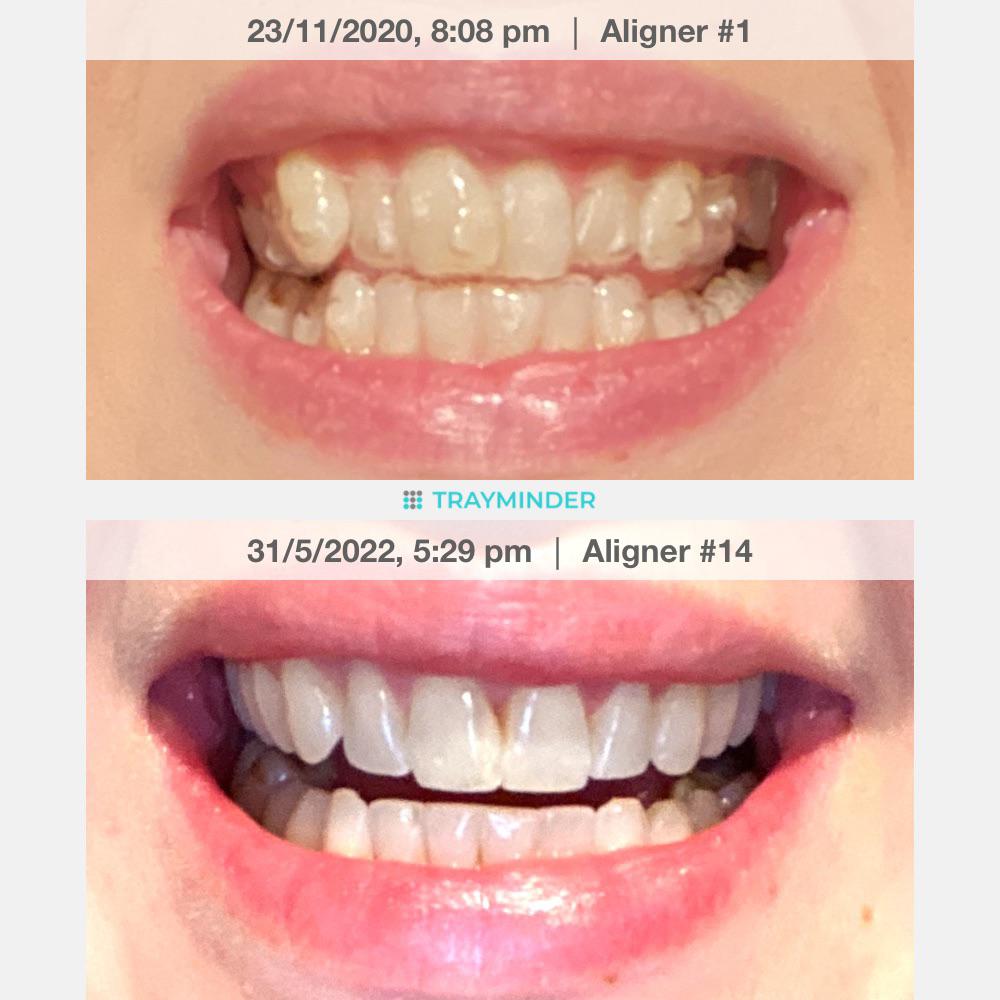 Finished! Invisalign lite, 3 rounds of 14 trays each. I couldn’t be