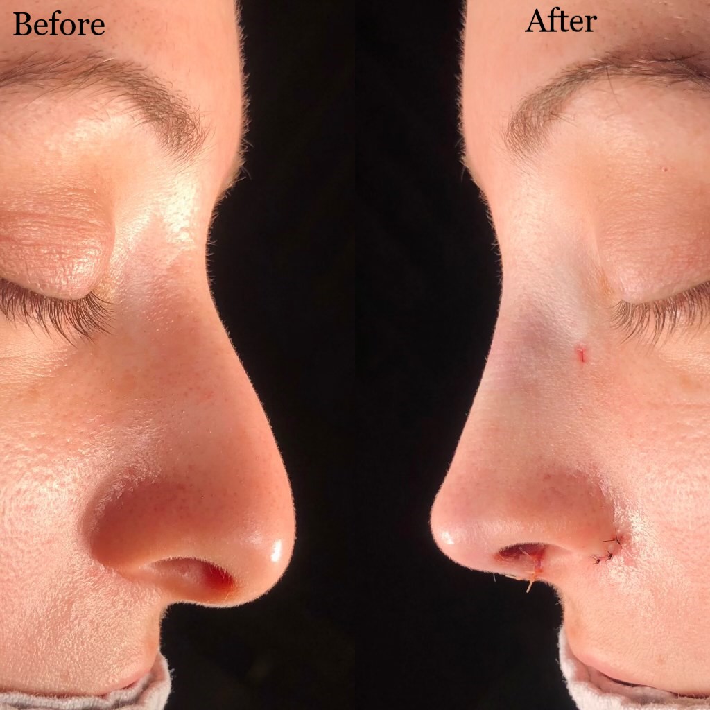 My open rhinoplasty by Dr Asaria (in Toronto) Immediate before