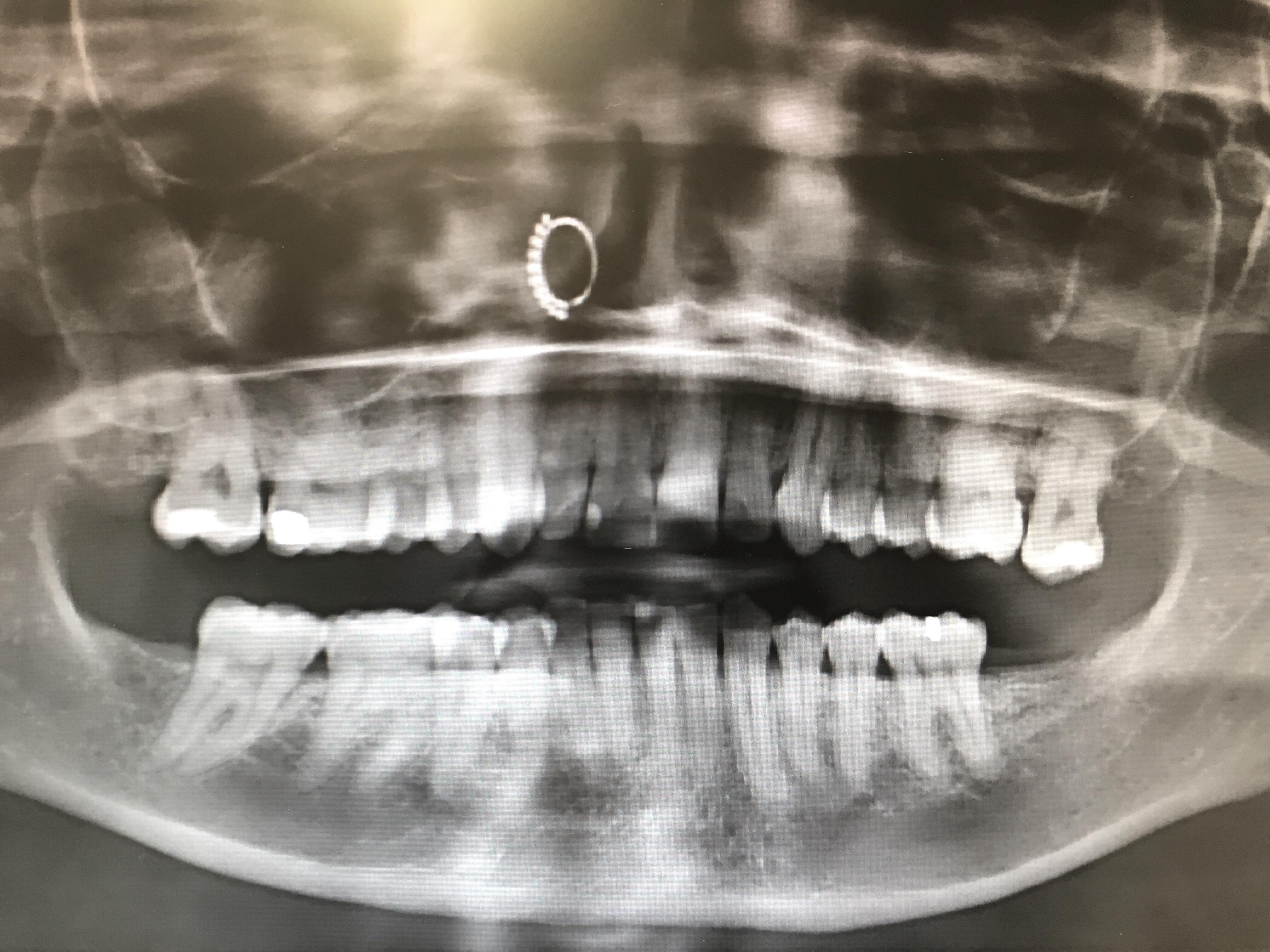 Got an X ray at the dentist and couldn’t take out my nose ring, so now