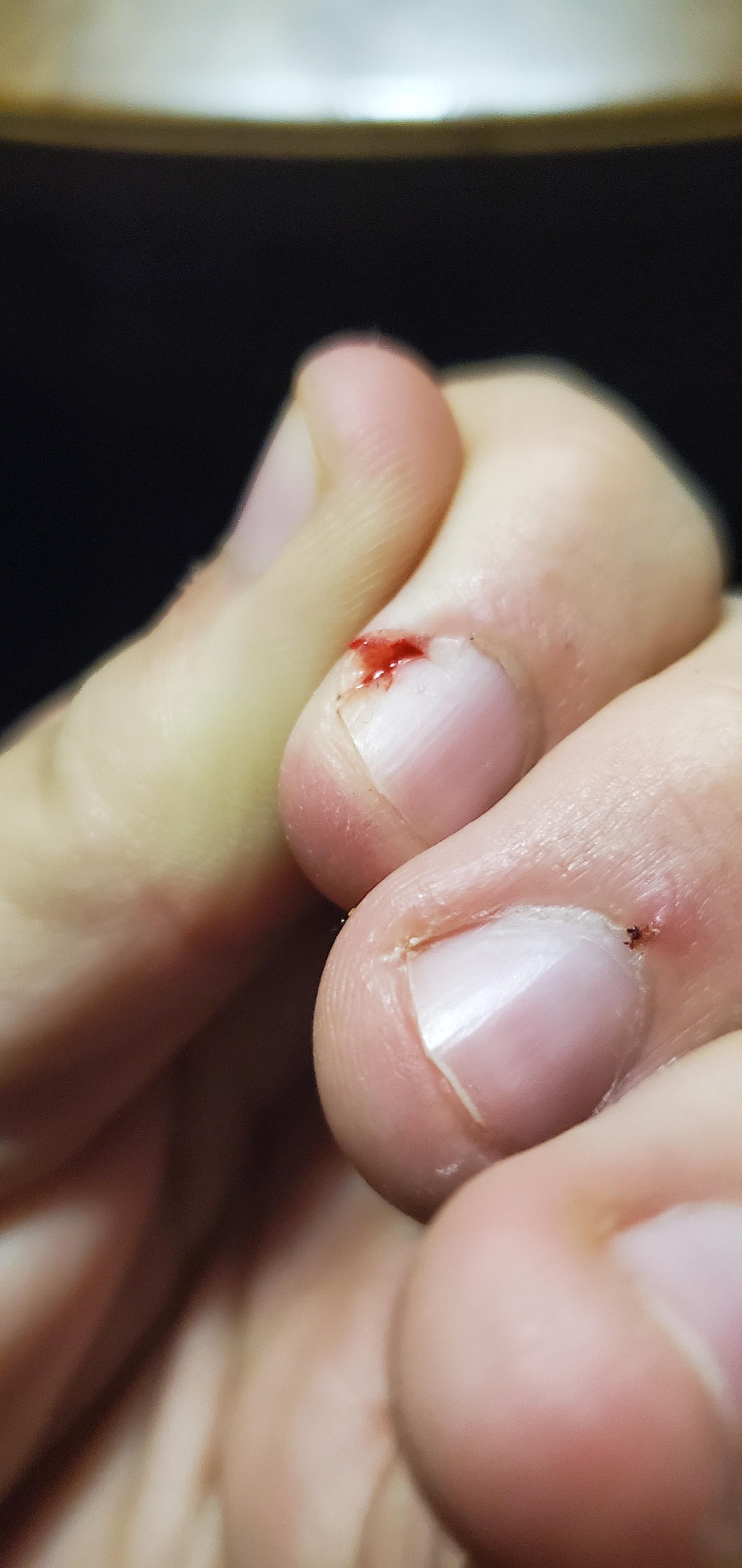 Pulled out an annoying hang nail and felt so nice r/popping
