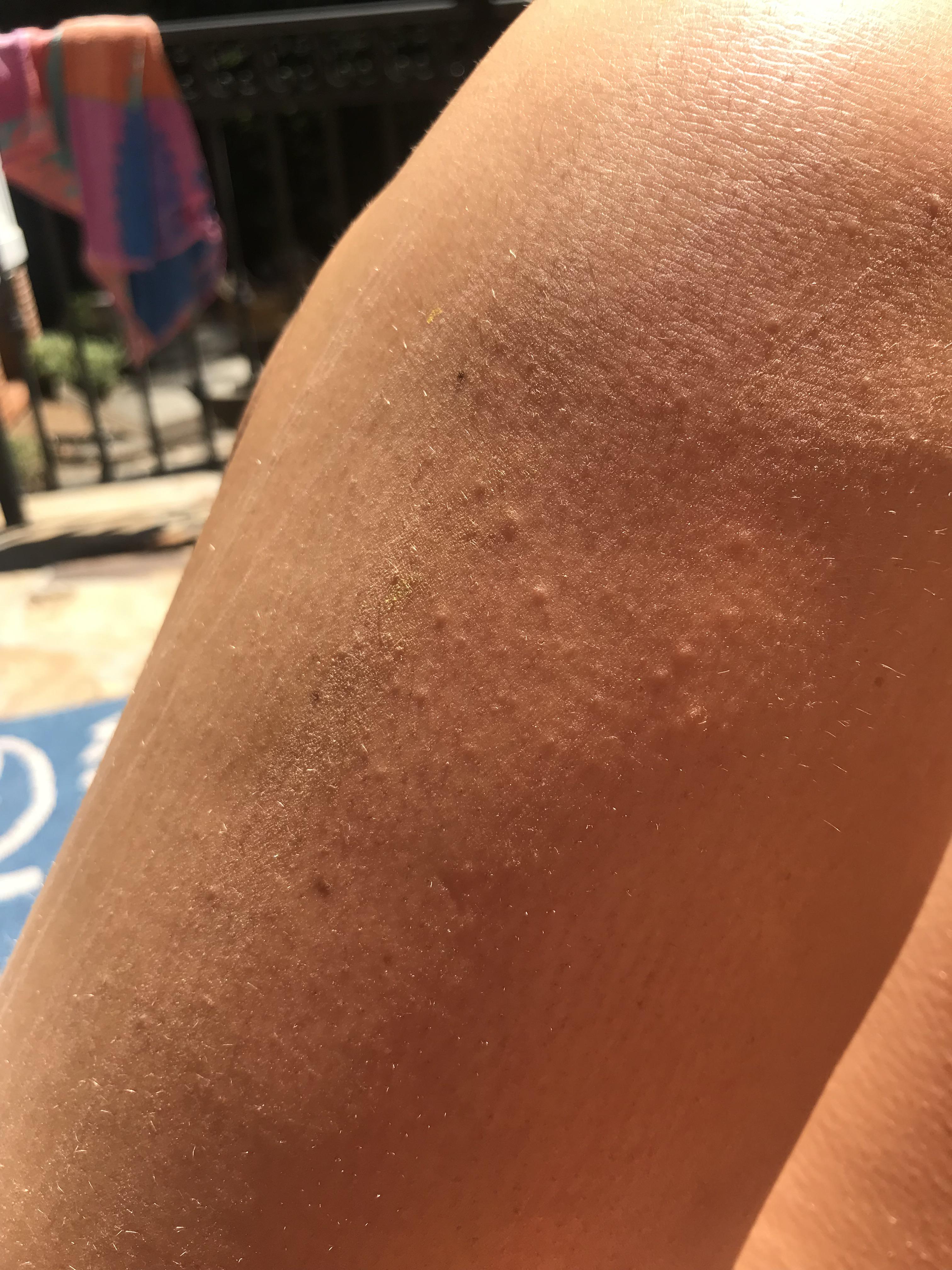 Mollescum Contagiosum?? I started itching my leg and looked at it and