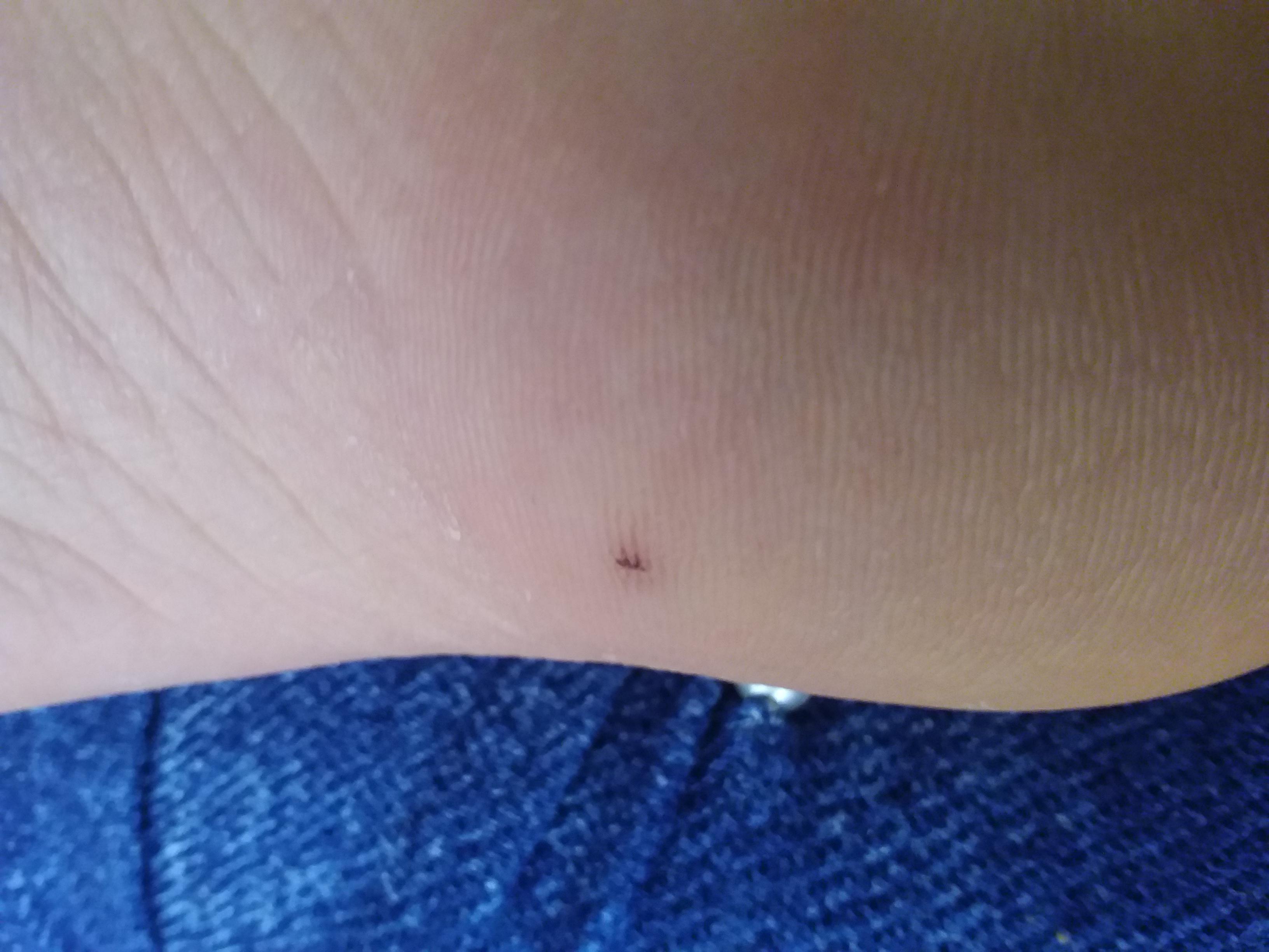 I have a glass shard in my foot,i do not know if it is infected,and i