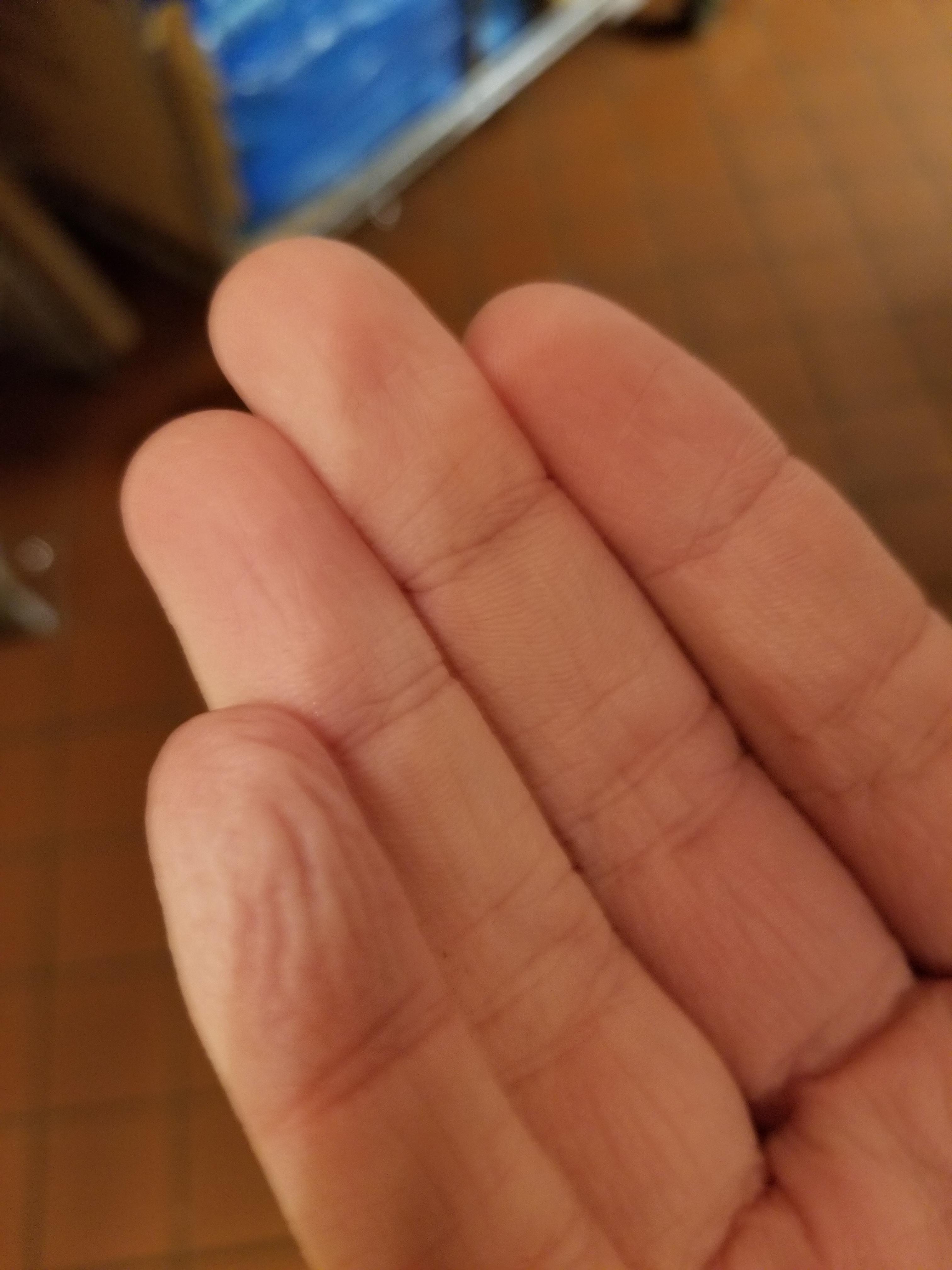 I work as a dishwasher and my fingertips are so damaged from picking up