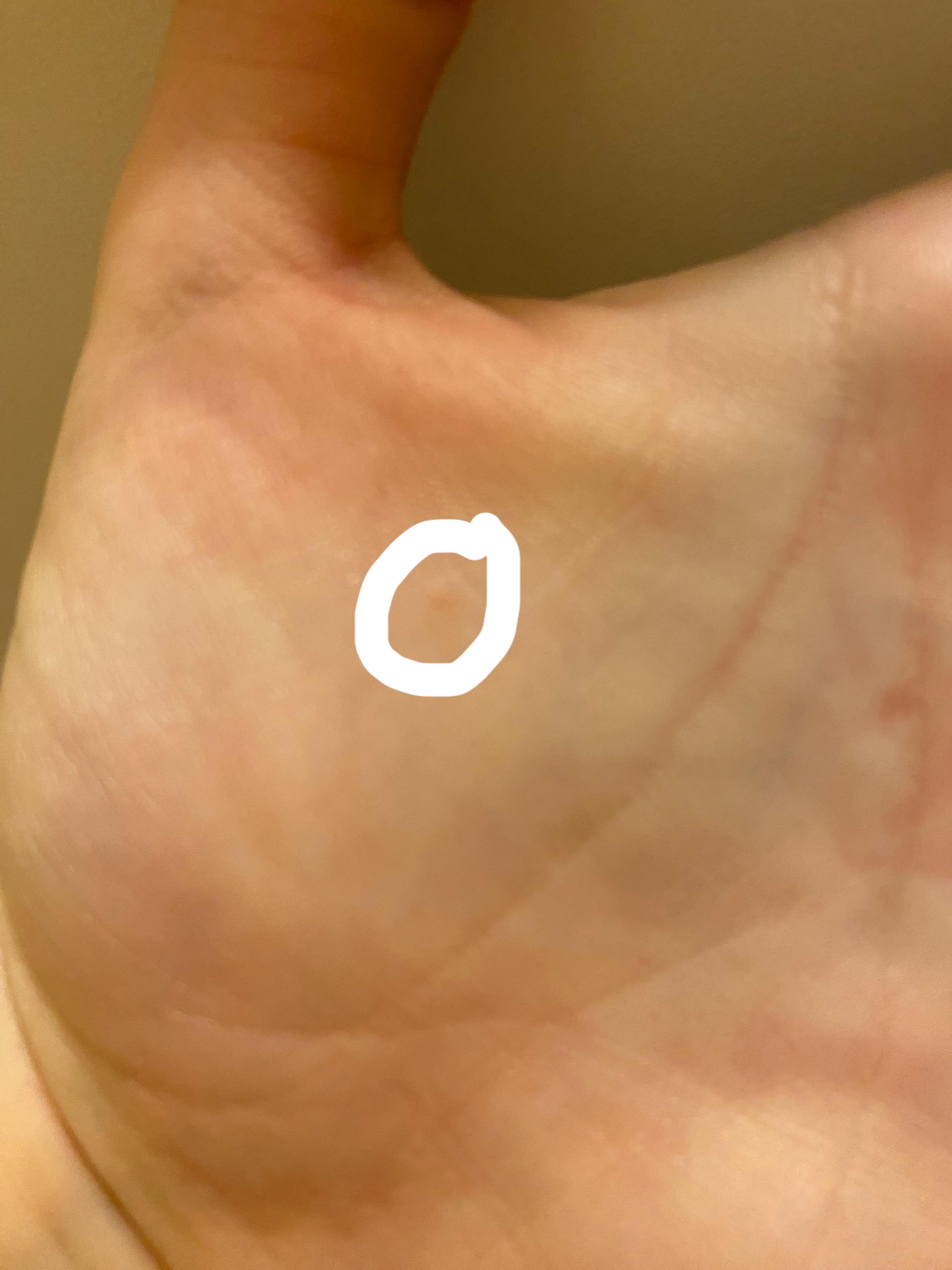 Does this look like the start of a wart? If so will it spread if i