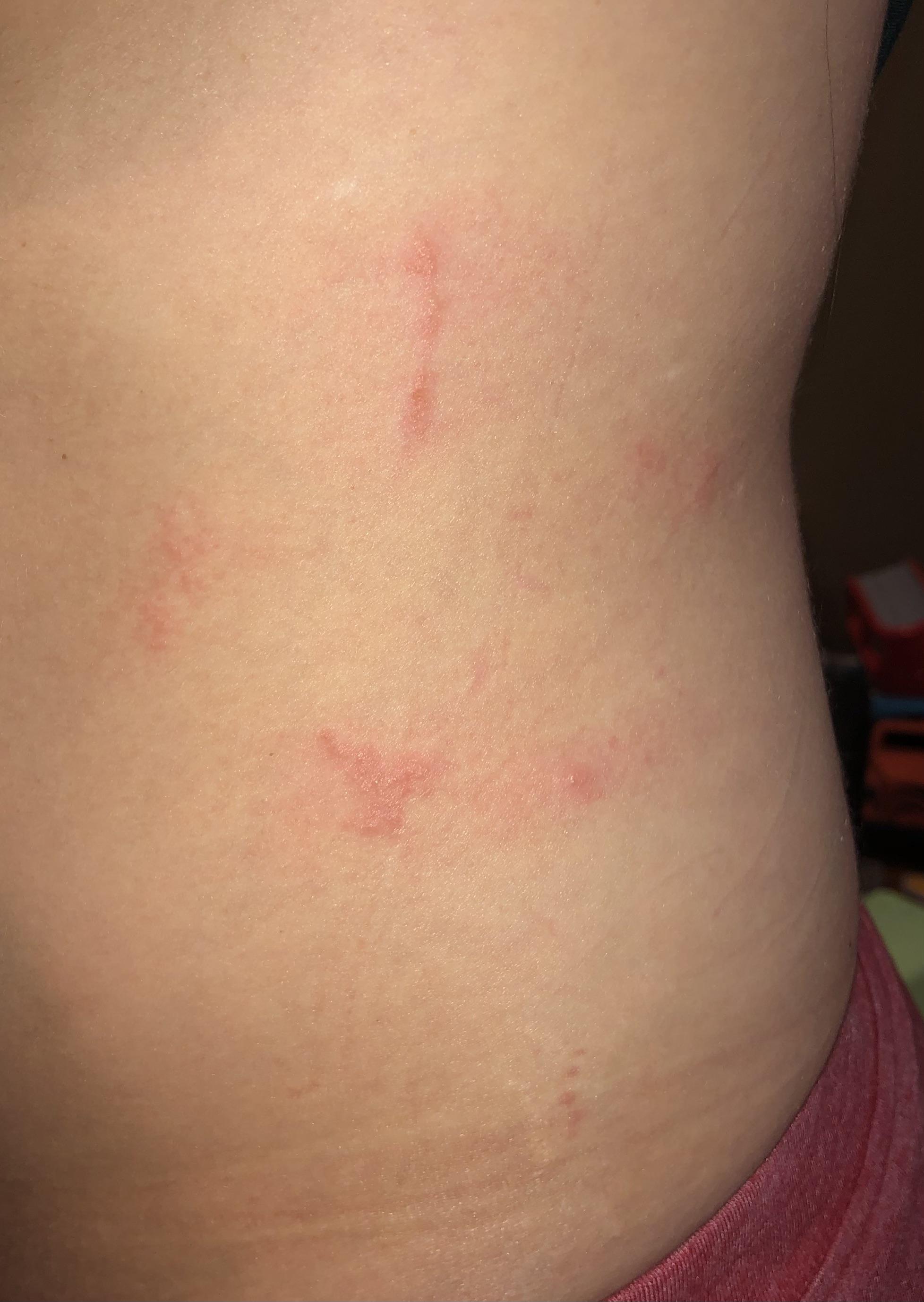 Oh yay I have it again shingles