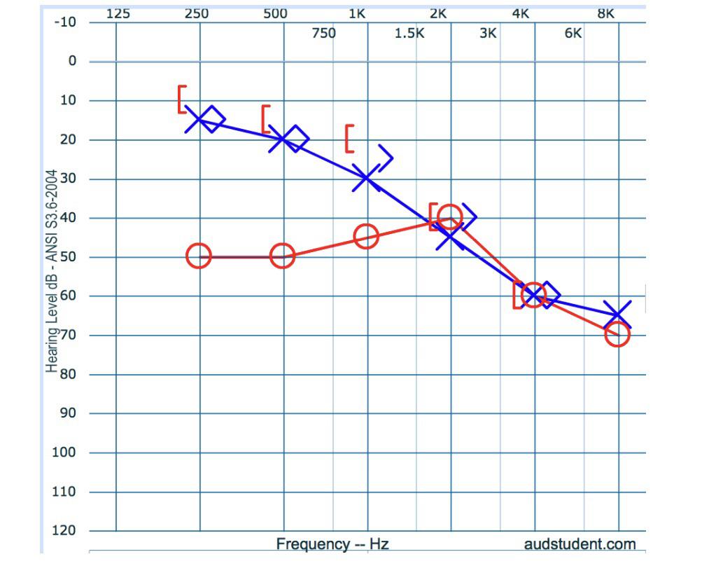 Is this a mixed hearing loss? I’m studying for a quiz r/audiology