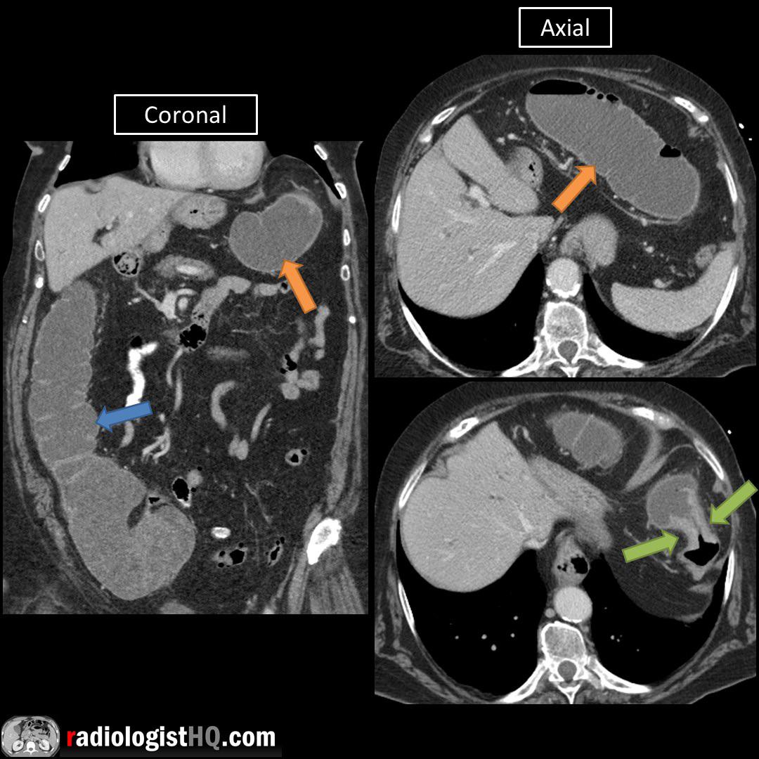 Large bowel obstruction due to applecore colon carcinoma on CT r