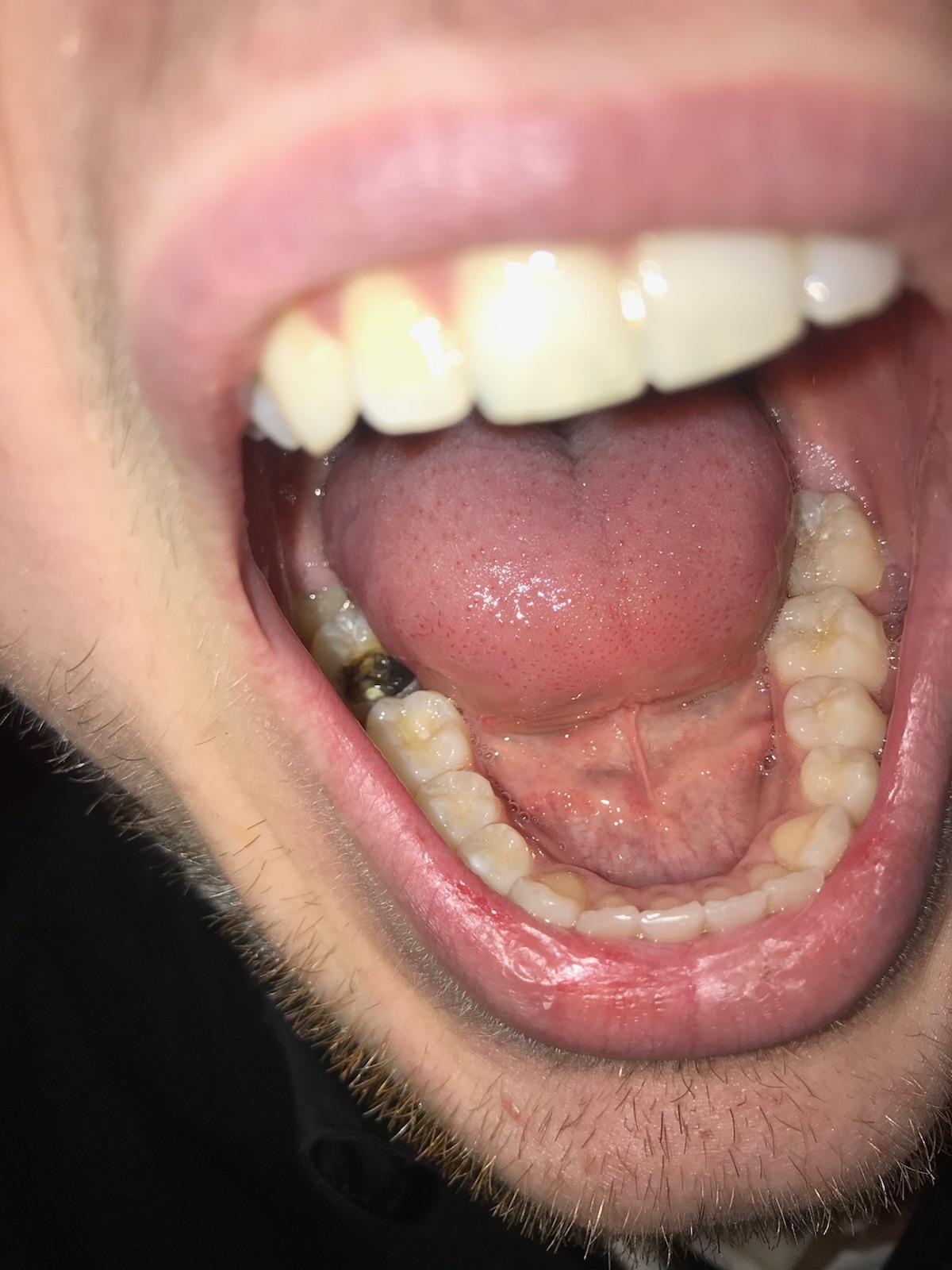 Filling Came Out While Chewing Gum to Reveal Massive Cavity r