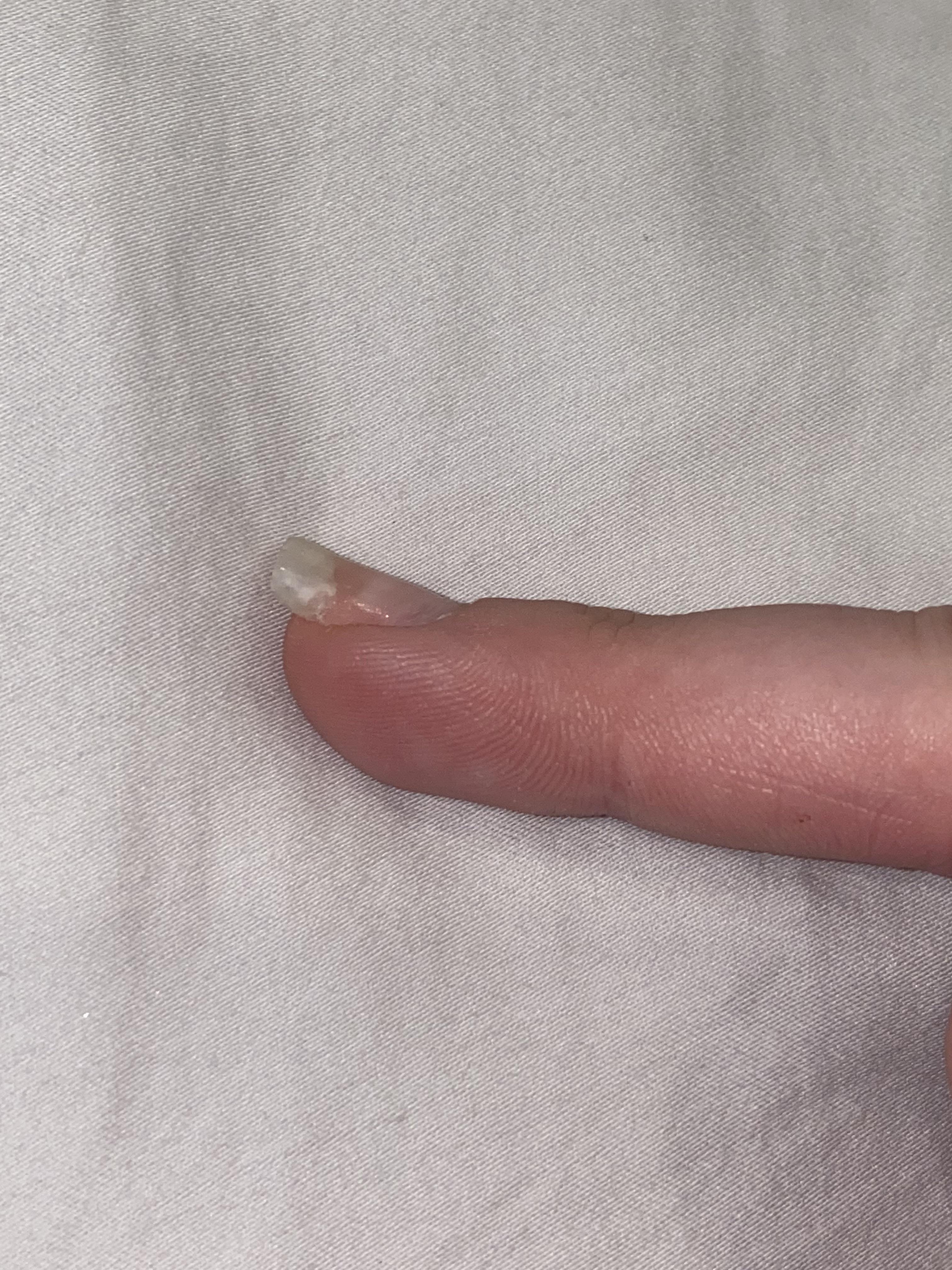 Anyone else have this problem after growing back nails? They all grow