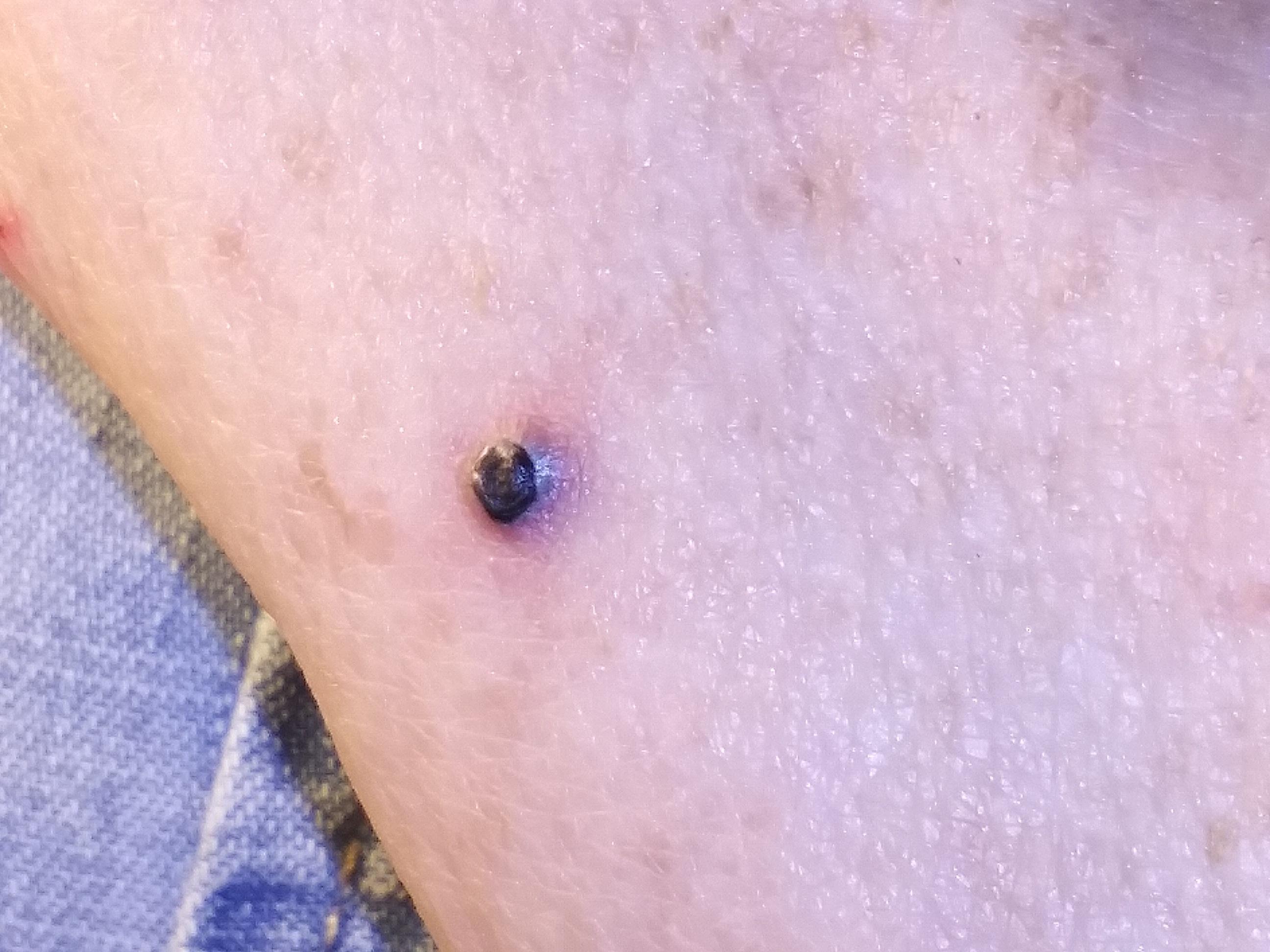 Blood blister or something else on my mom's arm. It's not very big
