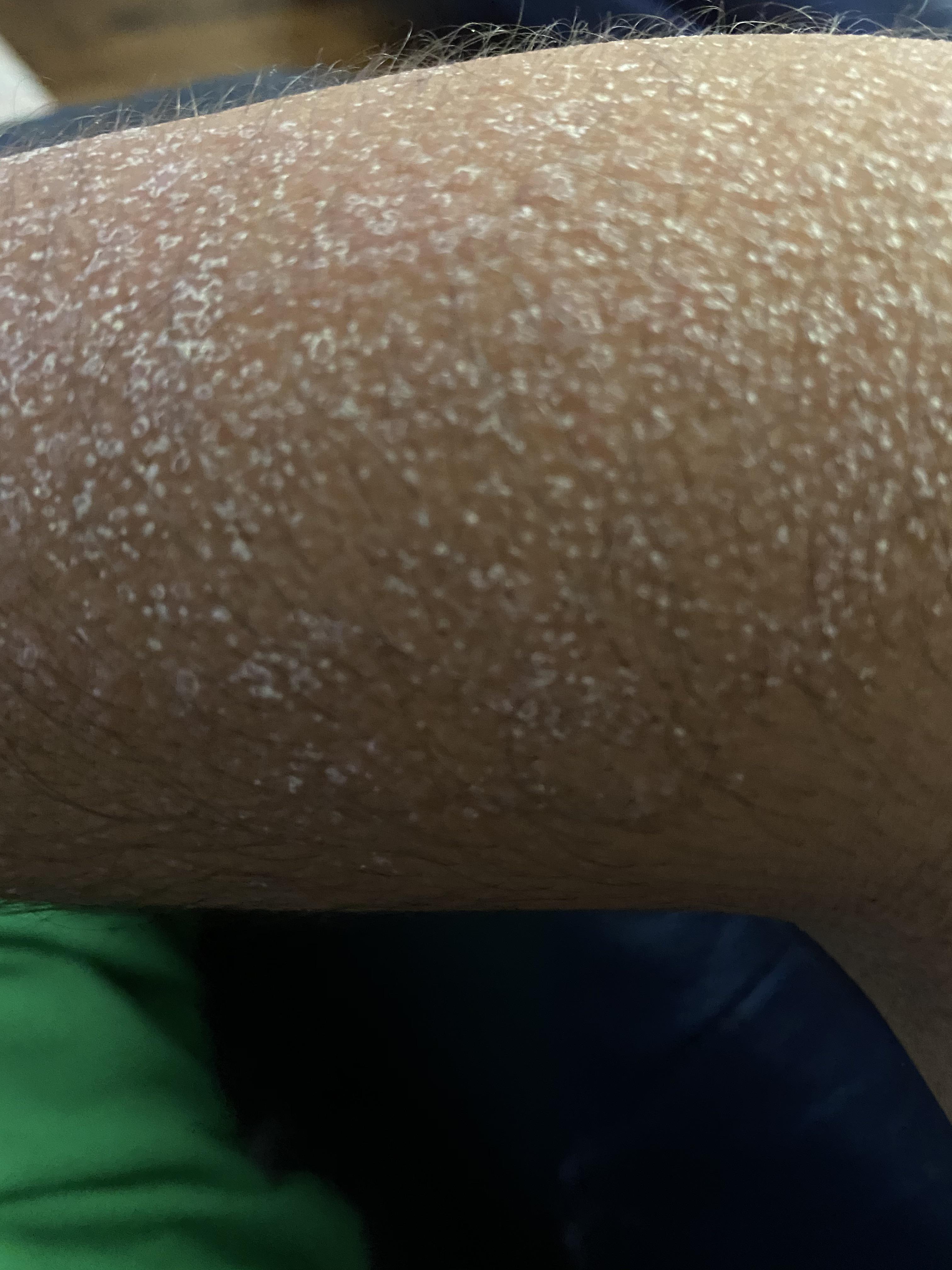 Dry skin like this all over my legs and arms, what could this possibly