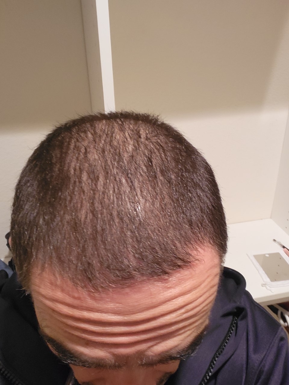 Thin Fine Hair or Balding ? r/malehairadvice
