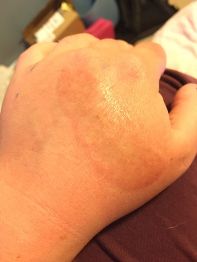 My curling iron burn scar I got when I was nine months old. The doctor