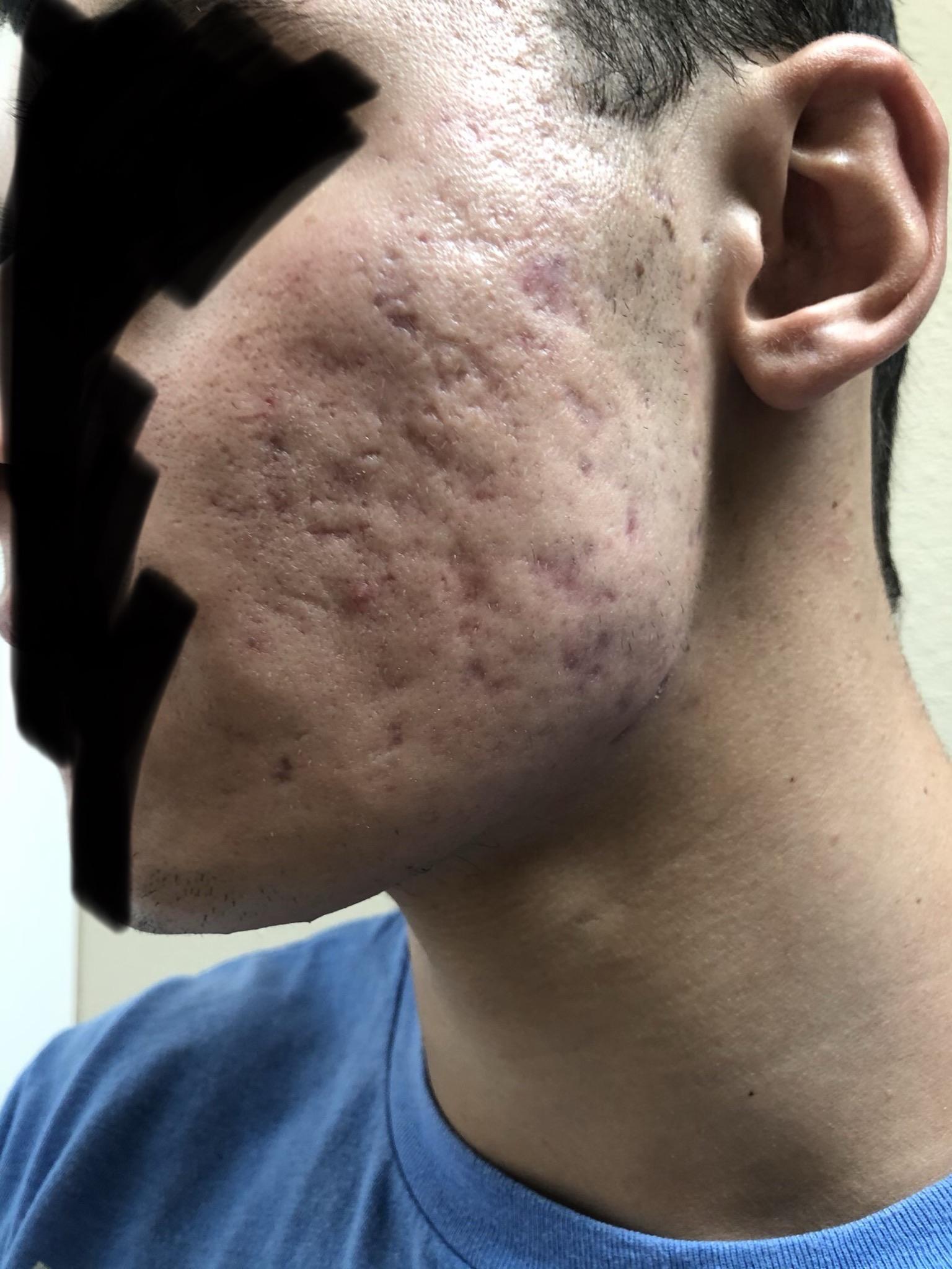 How To Treat Keloid Scars Reddit