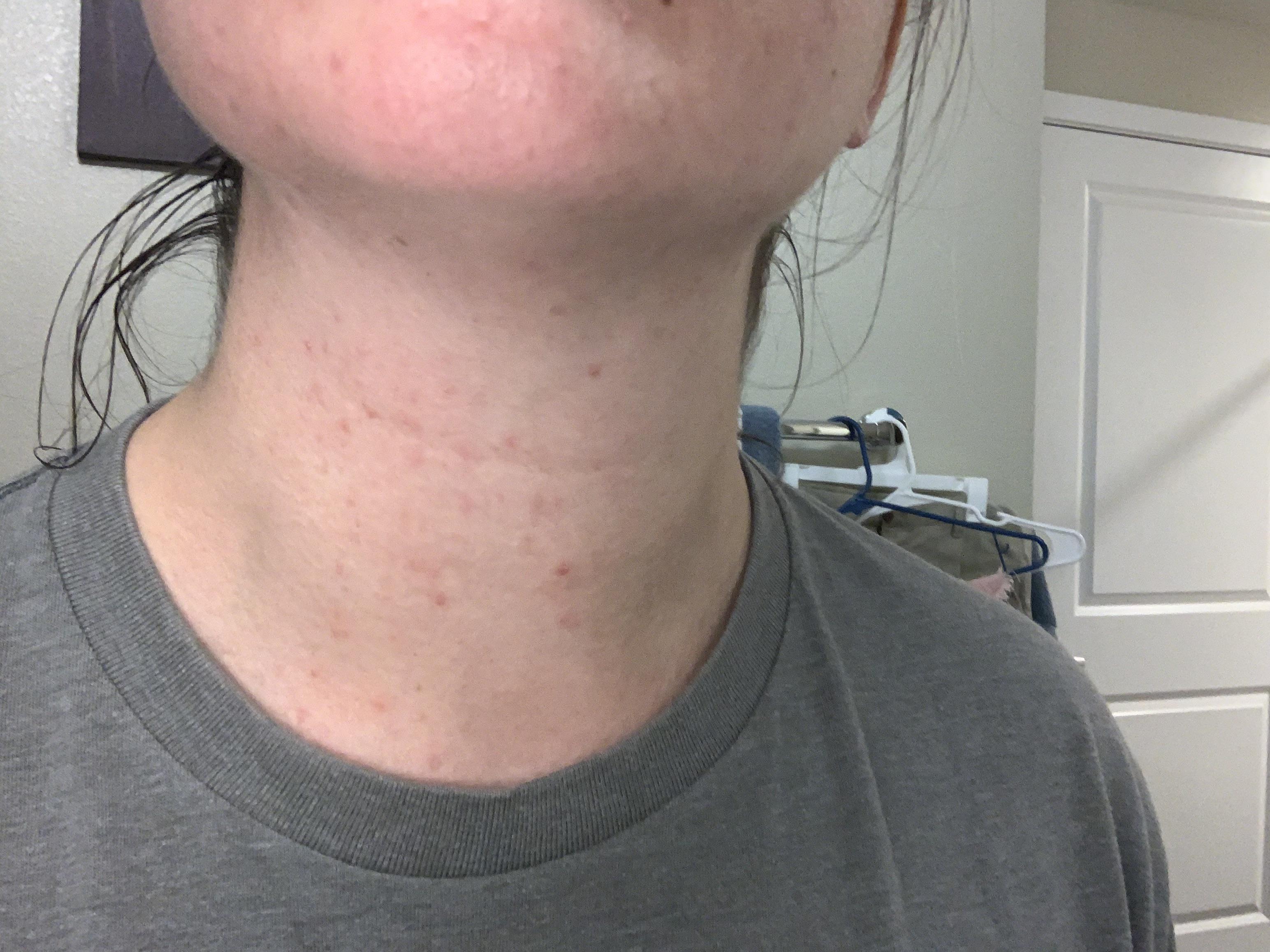 Rash on neck after staring 0.04 Tret? I had some neck acne before