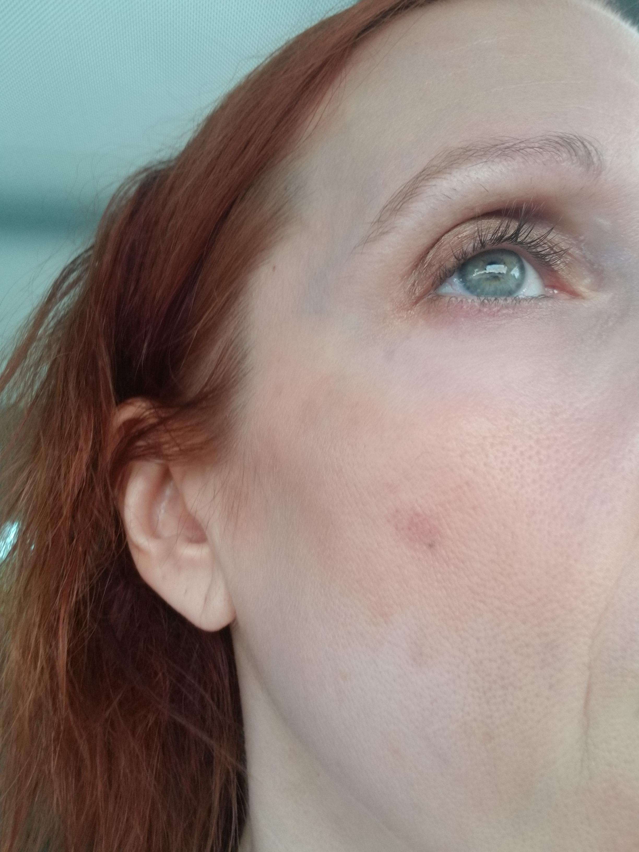 [Skin concerns] Help with red spot. Details in comments