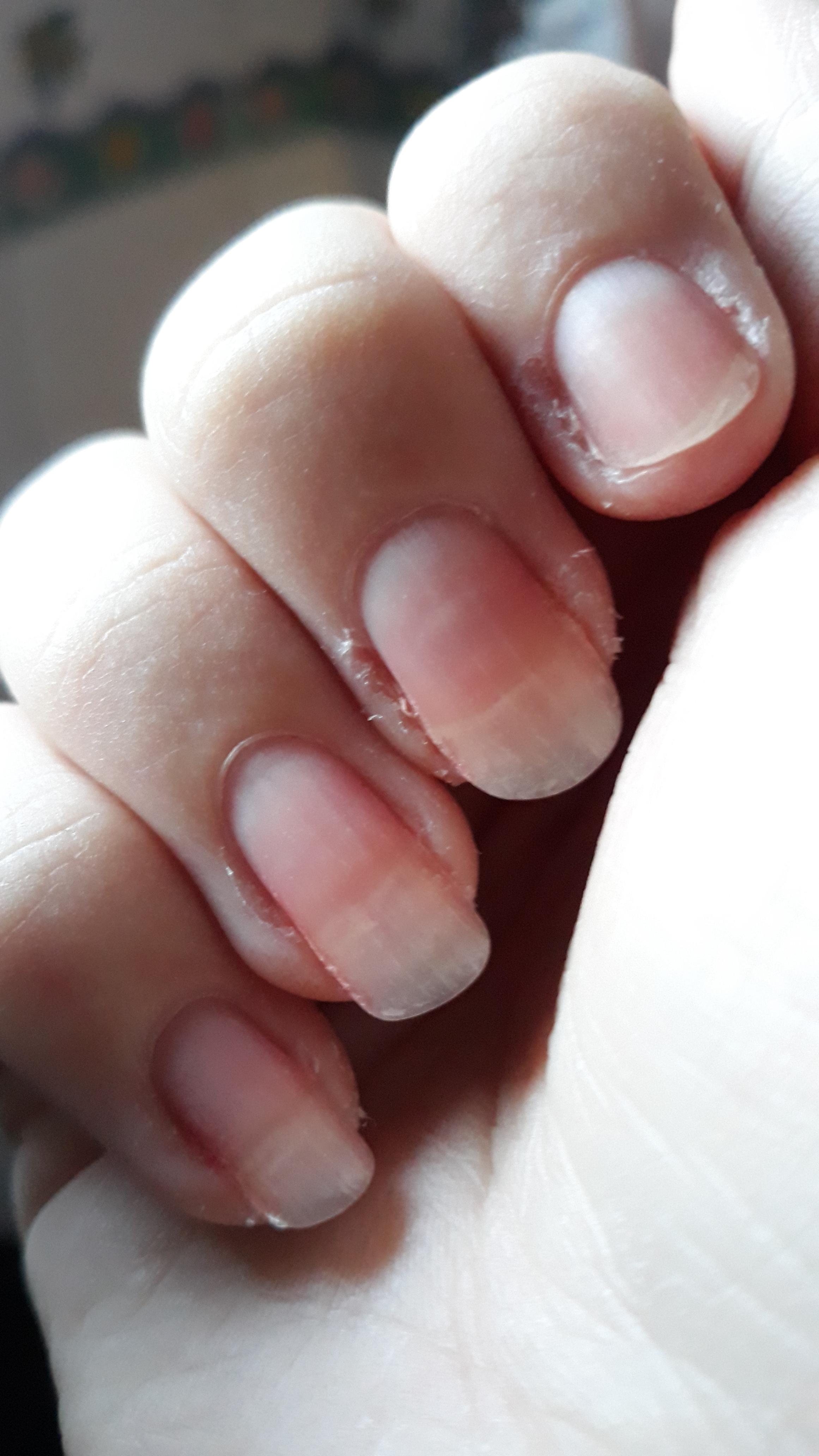 is the length of my nails detrimental to growing out my nail beds? r