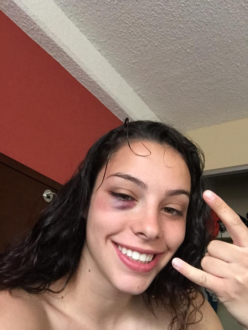 first black eye from the last game of the season r/rugbyunion