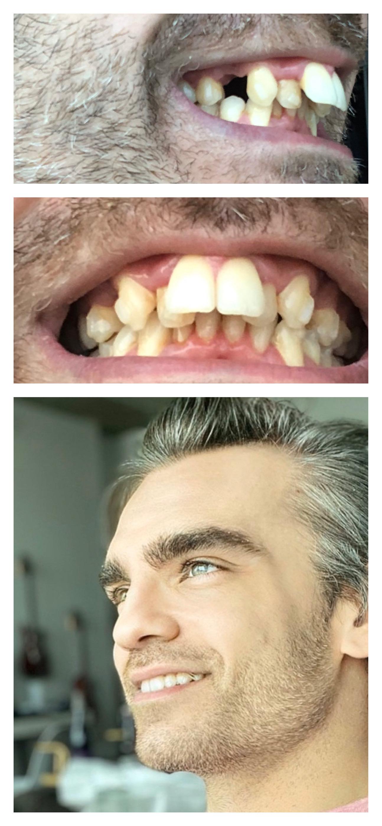 More progress pictures (before/before/after). Still learning how to do