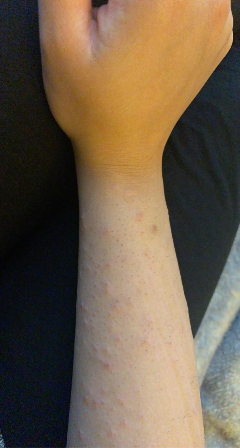 Crazy itching won’t stopIve never had this in my life. Came out of