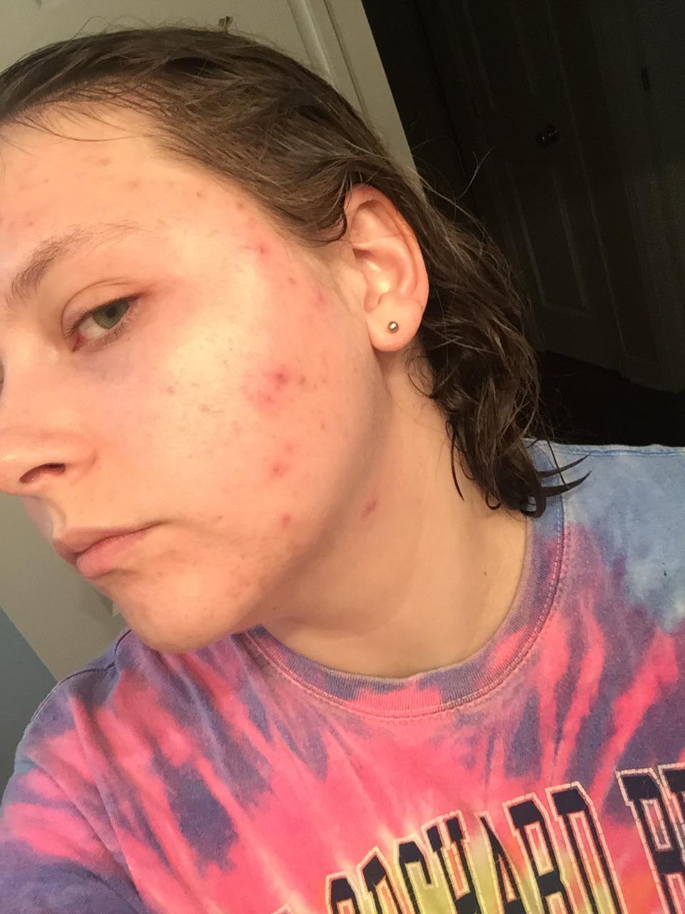 12 years of acne.... r/acne