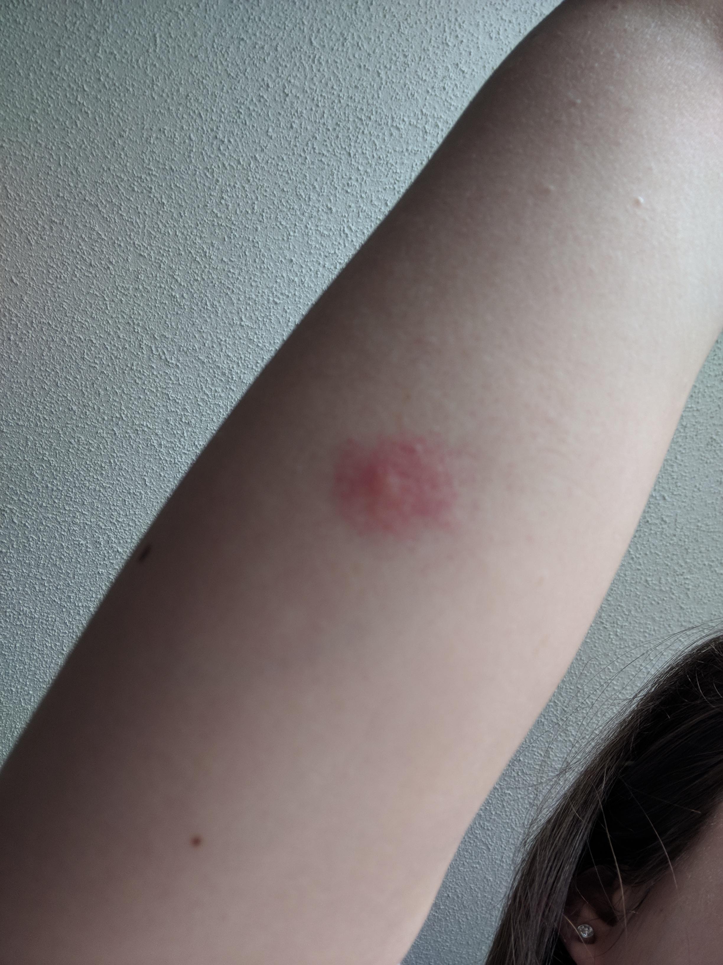 I found one bed bug, is this a bite? Bedbugs