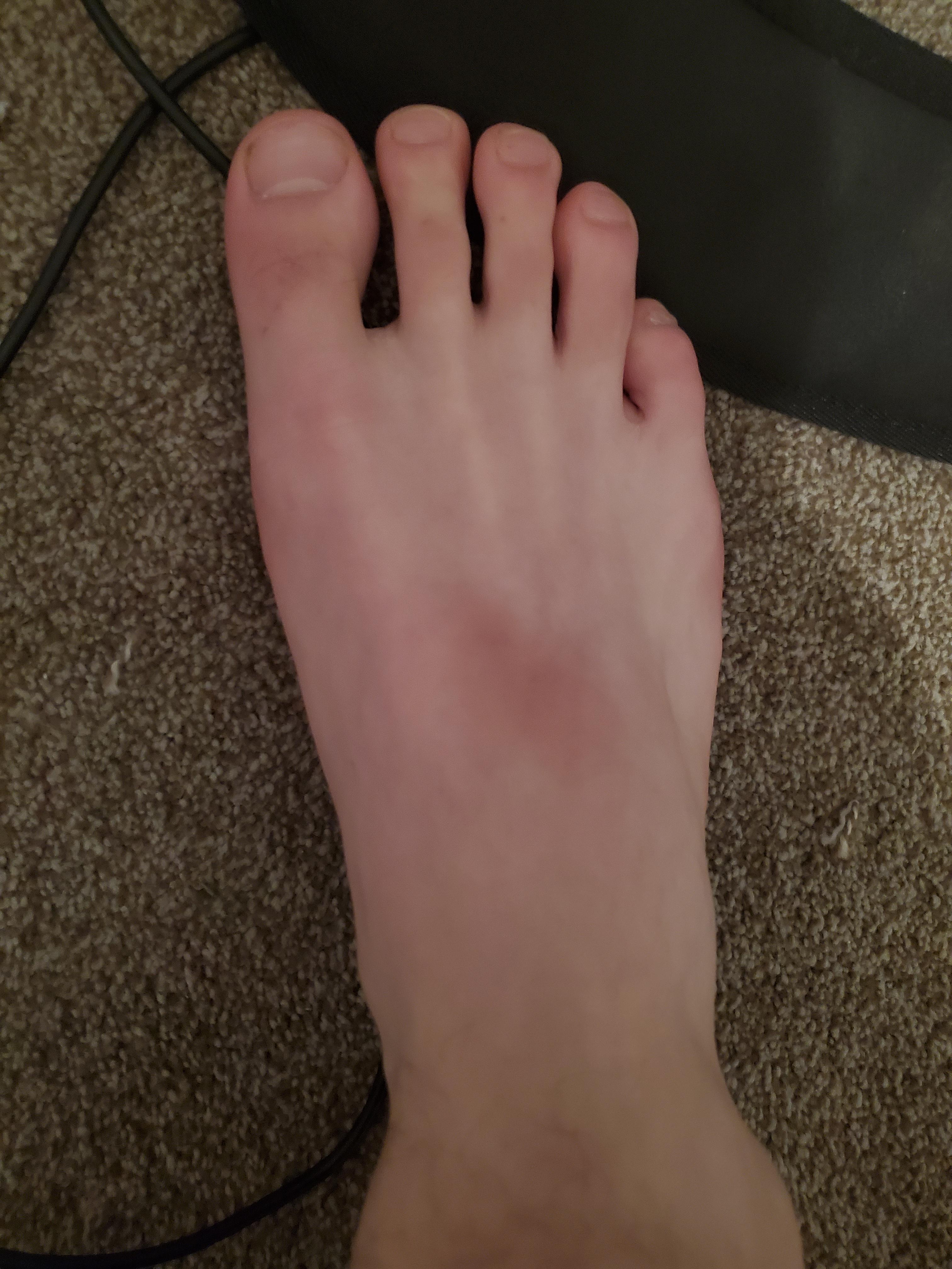 Foot has brown discoloration in the middle, also one on the ball of my