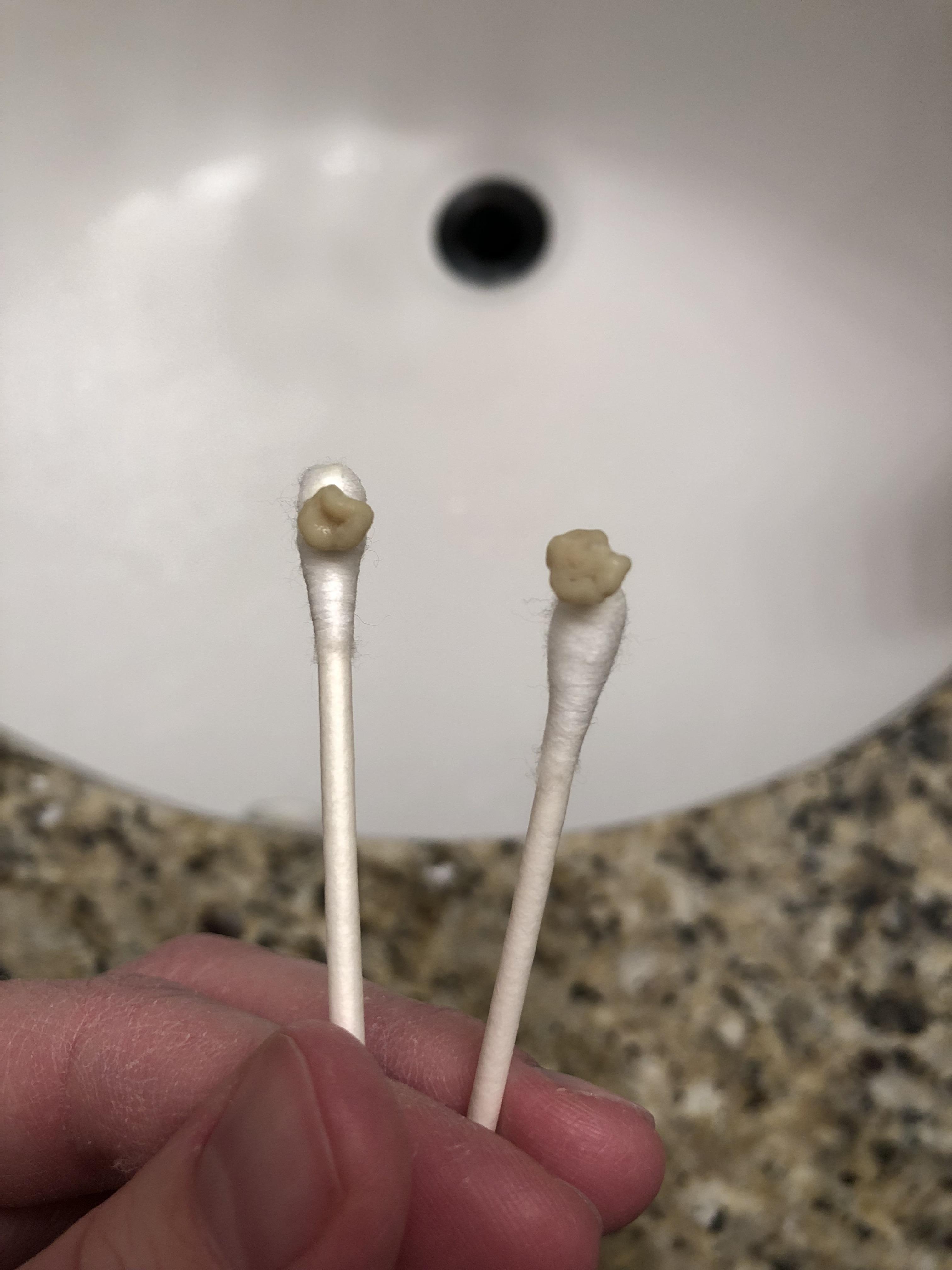 Two tonsil stones I got out after being sick for a week. The smell was