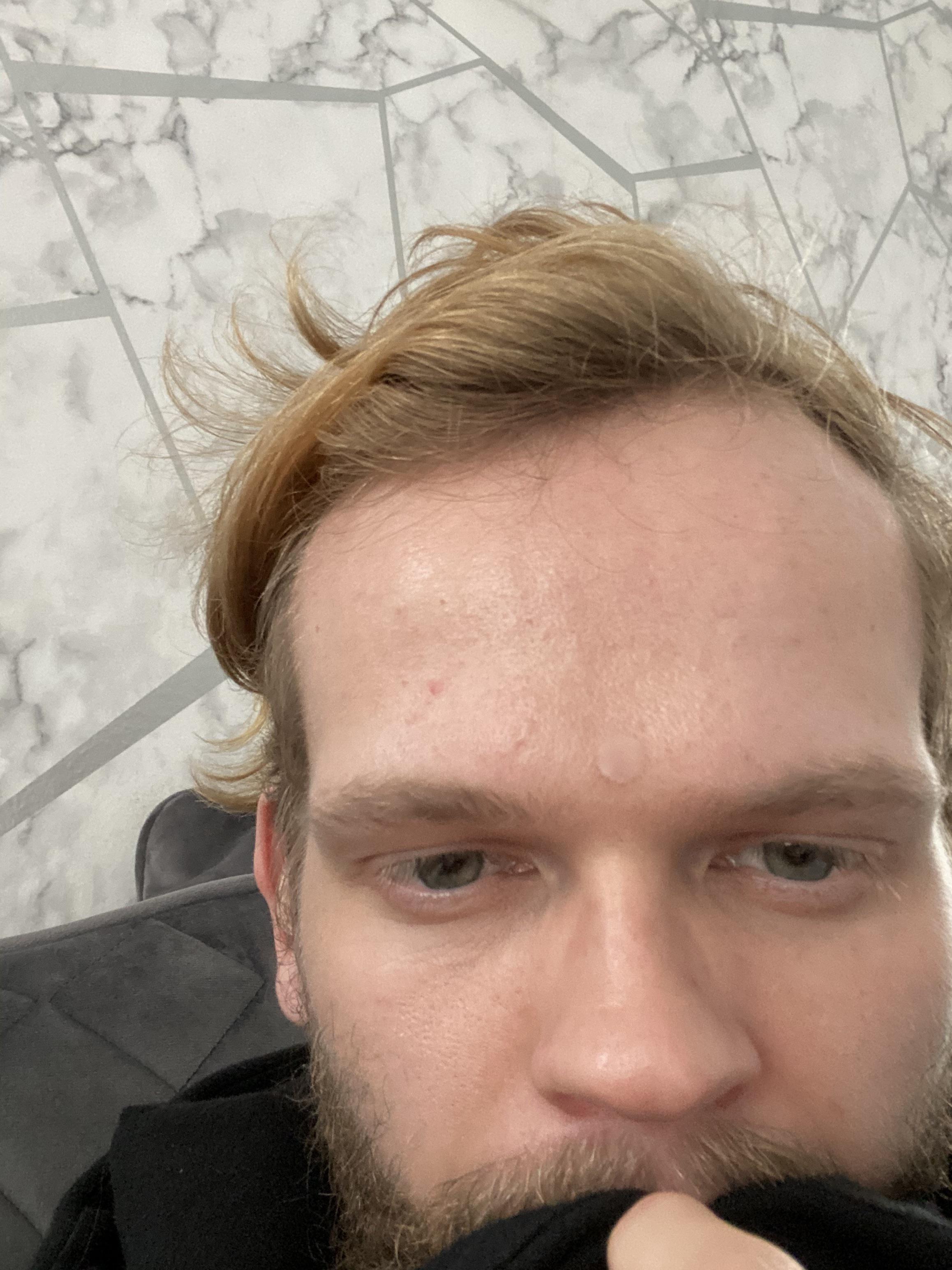 Help Iv been using duac and simple moz for years but not happy, also