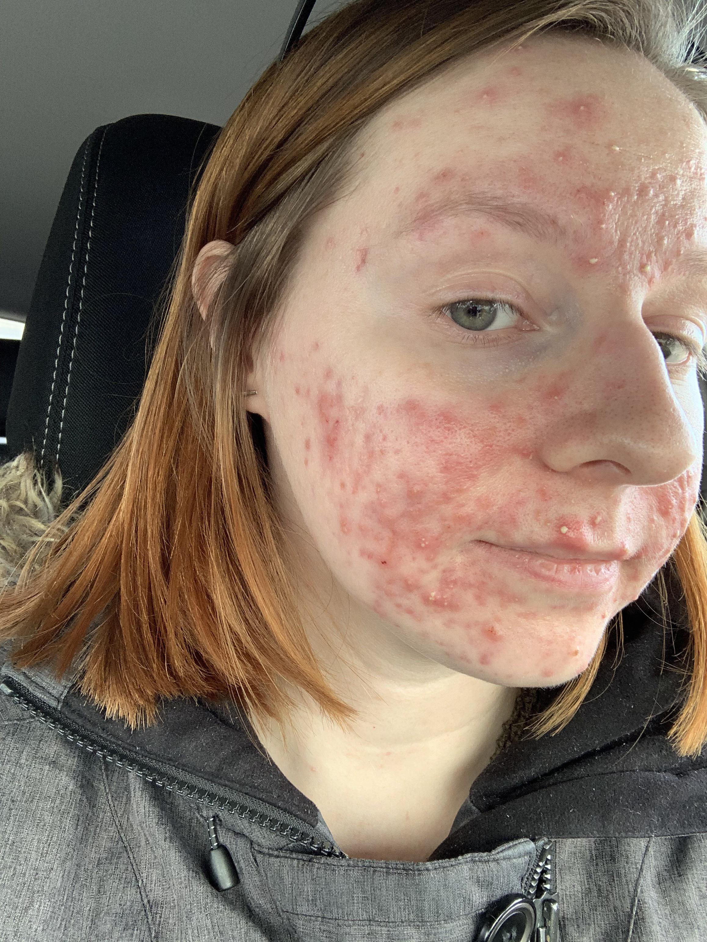 4 years post Accutane Has anyone found a permanent solution for dry