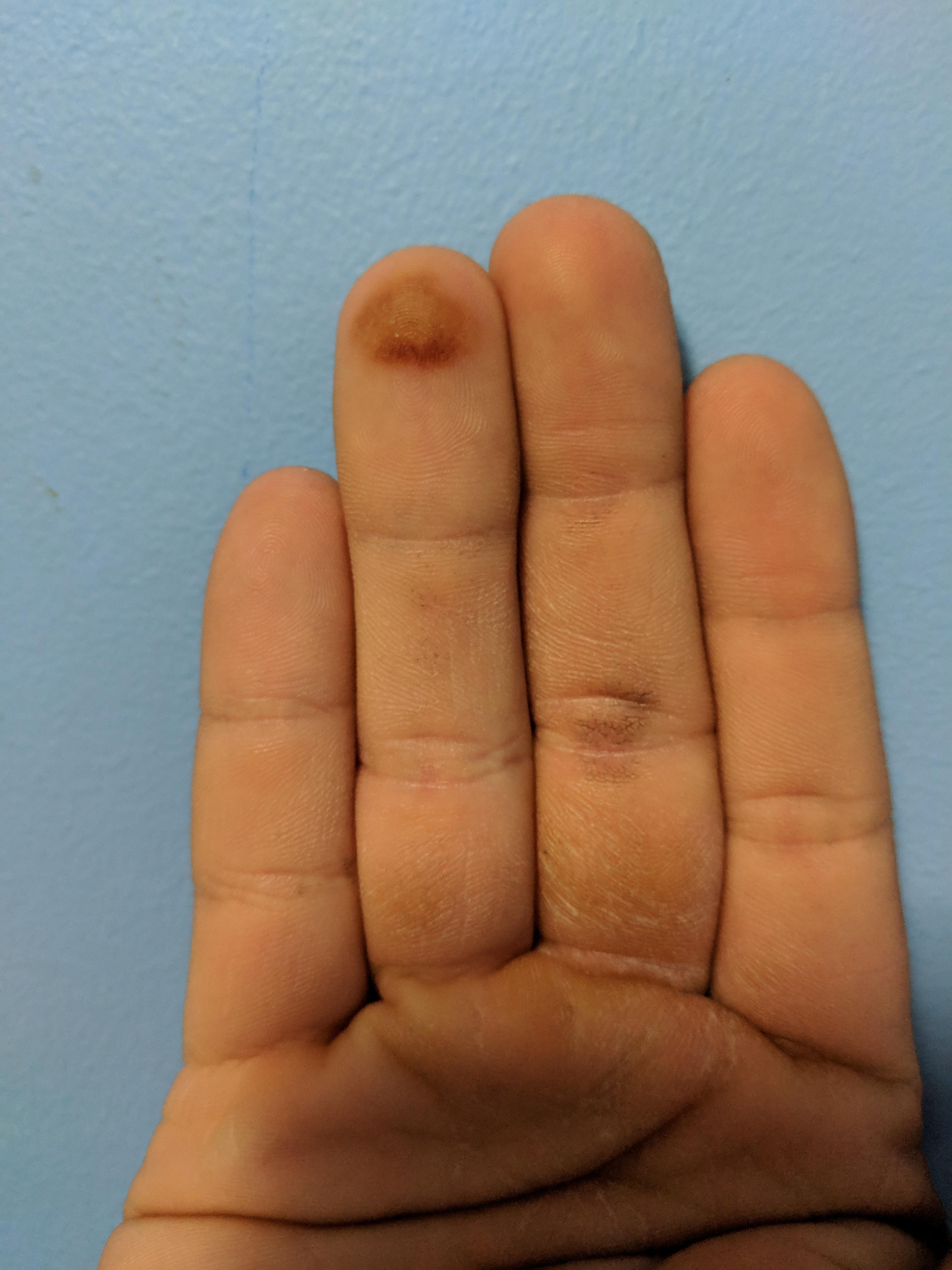 Does anyone know what about my release would cause a callus like that
