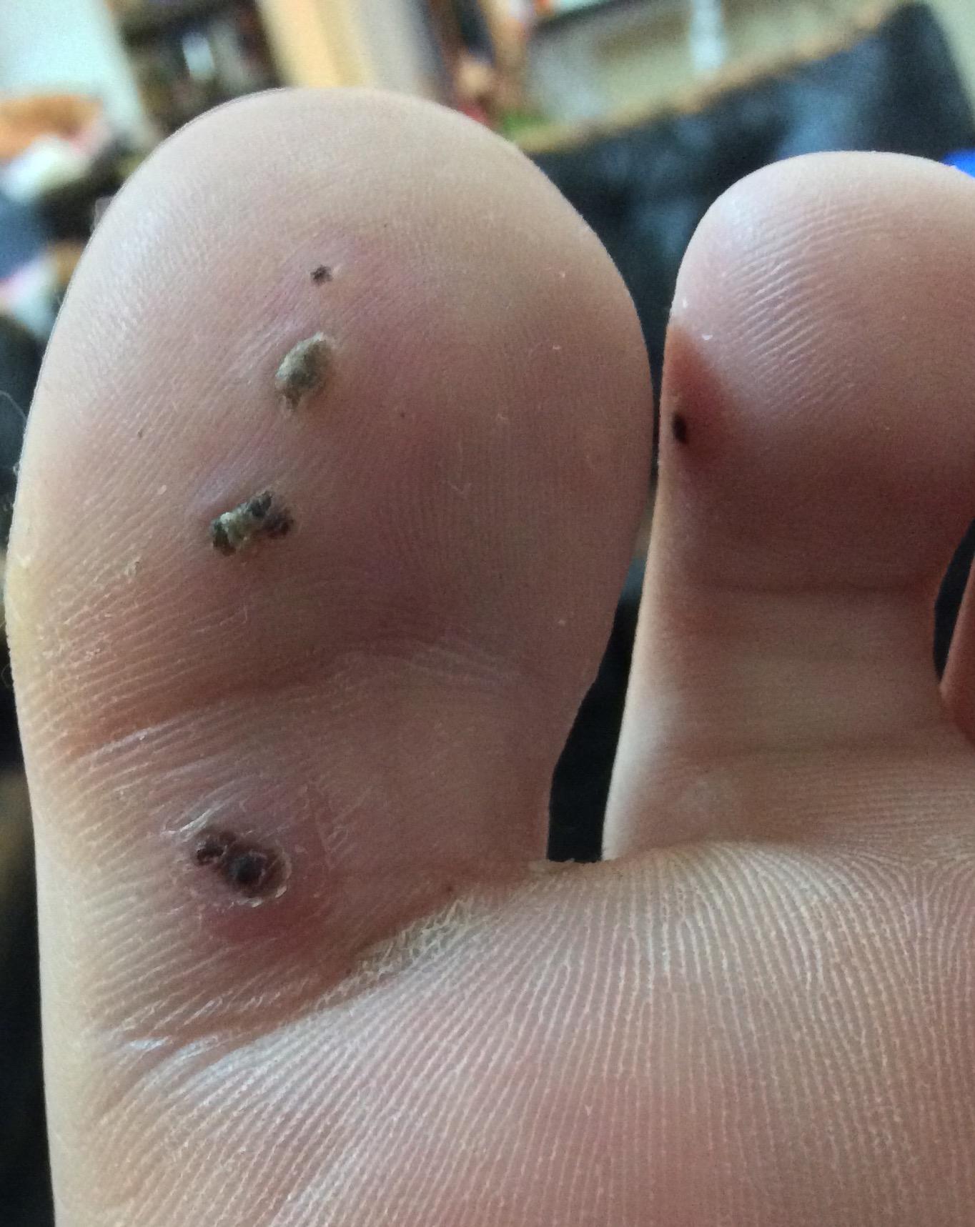 Vinegar Wart Treatment