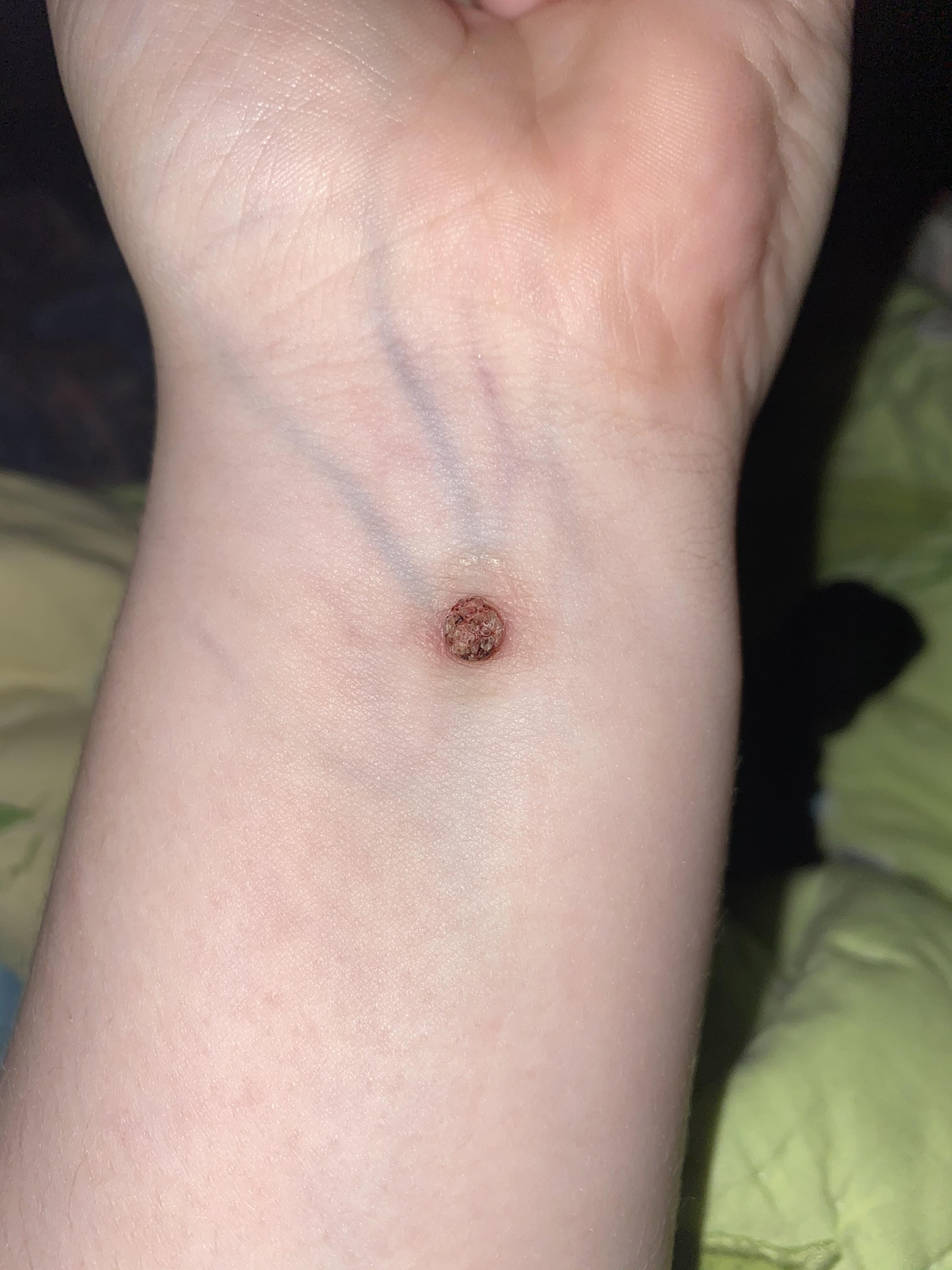 What's wrong with my wart? i'm getting it removed on tuesday but it